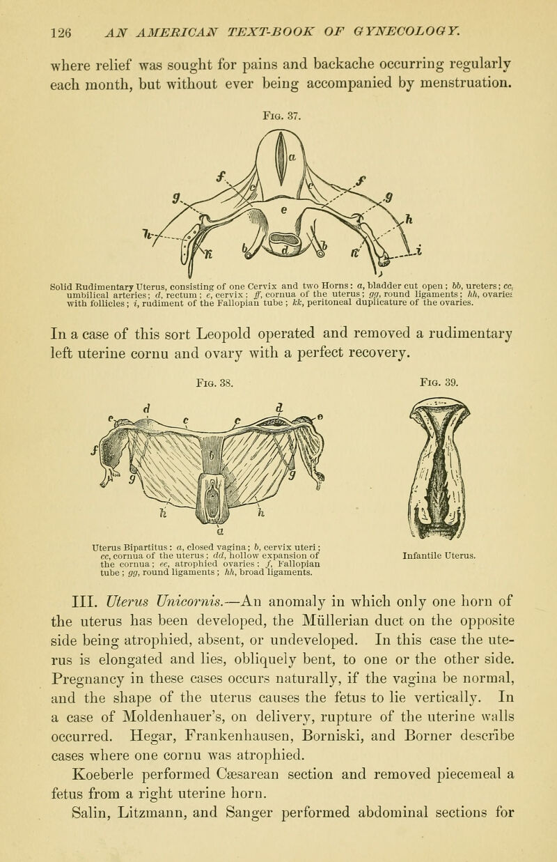 where relief was sought for pains and backache occurring regularly each month, but without ever being accompanied by menstruation. Fig. 37. Solid Rudimentary Uterus, consisting of one Cervix and two Horns: a, bladder cut open; 66, ureters; cc. umbilical arteries; d, rectum; e, cervix; ff, cornua of the uterus; gg, round ligaments; hh, ovaries with follicles ; i, rudiment of the Fallopian tube ; kk, peritoneal duplicature of the ovaries. In a case of this sort Leopold operated and removed a rudimentary left uterine cornu and ovary with a perfect recovery. Fig. 38. Fig. 39. Uterus Bipartitus : a, closed vagina; 6, cervix uteri; cc, cornua of the uterus; dd, hollow expansion of the cornua; ee, atrophied ovaries; /, Fallopian tube ; gg, round ligaments ; hh, broad ligaments. Infantile Uterus. III. Uterus Unicornis.—An anomaly in which only one horn of the uterus has been developed, the Miillerian duct on the opposite side being atrophied, absent, or undeveloped. In this case the ute- rus is elongated and lies, obliquely bent, to one or the other side. Pregnancy in these cases occurs naturally, if the vagina be normal, and the shape of the uterus causes the fetus to lie vertically. In a case of Moldenhauer's, on delivery, rupture of the uterine walls occurred. Hegar, Frankenhausen, Borniski, and Borner describe cases where one cornu was atrophied. Koeberle performed Csesarean section and removed piecemeal a fetus from a right uterine horn. Salin, Litzmann, and Sanger performed abdominal sections for