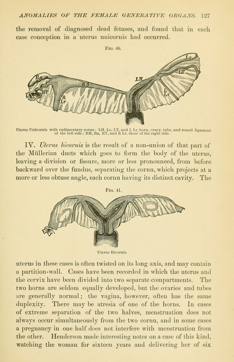 the removal of diagnosed dead fetuses, and found that in each case conception in a uterus unicornis had occurred. Fig. 40. Uterus Unicornis with rudimentary cornu : LH, Lo, LT, and L Lr, horn, ovary, tube, and round ligament of the left side; RH, Ro, RT, and R Lr, those of the right side. IV. Uterus bicomis is the result of a non-union of that part of the Miillerian ducts which goes to form the body of the uterus, leaving a division or fissure, more or less pronounced, from before backward over the fundus, separating the cornu, which projects at a more or less obtuse angle, each cornu having its distinct cavity. The Fig. 41. Uterus Bicornis. uterus in these cases is often twisted on its long axis, and may contain a partition-wall. Cases have been recorded in which the uterus and the cervix have been divided into two separate compartments. The two horns are seldom equally developed, but the ovaries and tubes are generally normal; the vagina, however, often has the same duplexity. There may be atresia of one of the horns. In cases of extreme separation of the two halves, menstruation does not always occur simultaneously from the two cornu, and in some cases a pregnancy in one half does not interfere with menstruation from the other. Henderson made interesting notes on a case of this kind, watching the woman for sixteen years and delivering her of six
