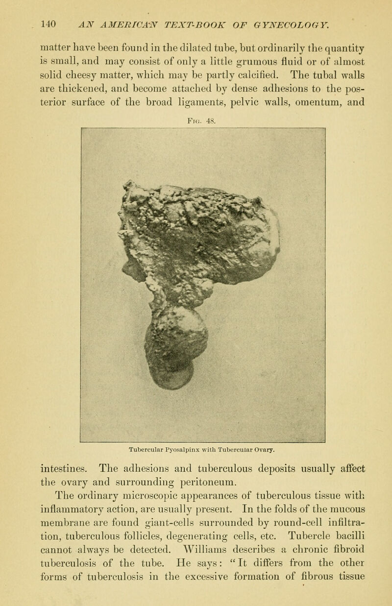 matter have been found in the dilated tube, but ordinarily the quantity- is small, and may consist of only a little grumous fluid or of almost solid cheesy matter, which may be partly calcified. The tubal walls are thickened, and become attached by dense adhesions to the pos- terior surface of the broad ligaments, pelvic walls, omentum, and Tubercular Pyosalpinx with Tubercular Ovary. intestines. The adhesions and tuberculous deposits usually affect the ovary and surrounding peritoneum. The ordinary microscopic appearances of tuberculous tissue with inflammatory action, are usually present. In the folds of the mucous membrane are found giant-cells surrounded by round-cell infiltra- tion, tuberculous follicles, degenerating cells, etc. Tubercle bacilli cannot always be detected. Williams describes a chronic fibroid tuberculosis of the tube. He says:  It differs from the other forms of tuberculosis in the excessive formation of fibrous tissue