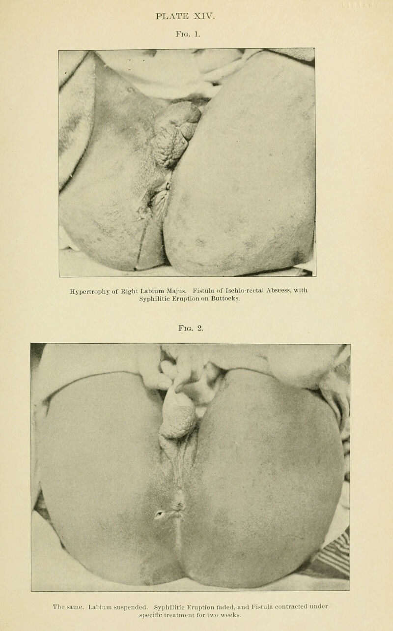 Fig. 1. Hypertrophy of Right Labium Majus. Fistula of Ischio-rectal Abscess, with Syphilitic Eruption on Buttocks. Fig. 2. r I The same. Labium suspended. Syphilitic Eruption faded, and Fistula contracted under specific treatment lor two weeks.