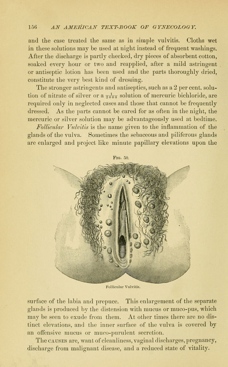 and the case treated the same as in simple vulvitis. Cloths wet in these solutions may be used at night instead of frequent washings. After the discharge is partly checked, dry pieces of absorbent cotton, soaked every hour or two and reapplied, after a mild astringent or antiseptic lotion has been used and the parts thoroughly dried, constitute the very best kind of dressing. The stronger astringents and antiseptics, such as a 2 per cent, solu- tion of nitrate of silver or a 2W0 solution of mercuric bichloride, are required only in neglected cases and those that cannot be frequently dressed. As the parts cannot be cared for as often in the night, the mercuric or silver solution may be advantageously used at bedtime. Follicular Vulvitis is the name given to the inflammation of the glands of the vulva. Sometimes the sebaceous and piliferous glands are enlarged and project like minute papillary elevations upon the Follicular Vulvitis. surface of the labia and prepuce. This enlargement of the separate glaDds is produced by the distension with mucus or muco-pus, which may be seen to exude from them. At other times there are no dis- tinct elevations, and the inner surface of the vulva is covered by an offensive mucus or muco-purulent secretion. The causes are, want of cleanliness, vaginal discharges, pregnancy, discharge from malignant disease, and a reduced state of vitality.