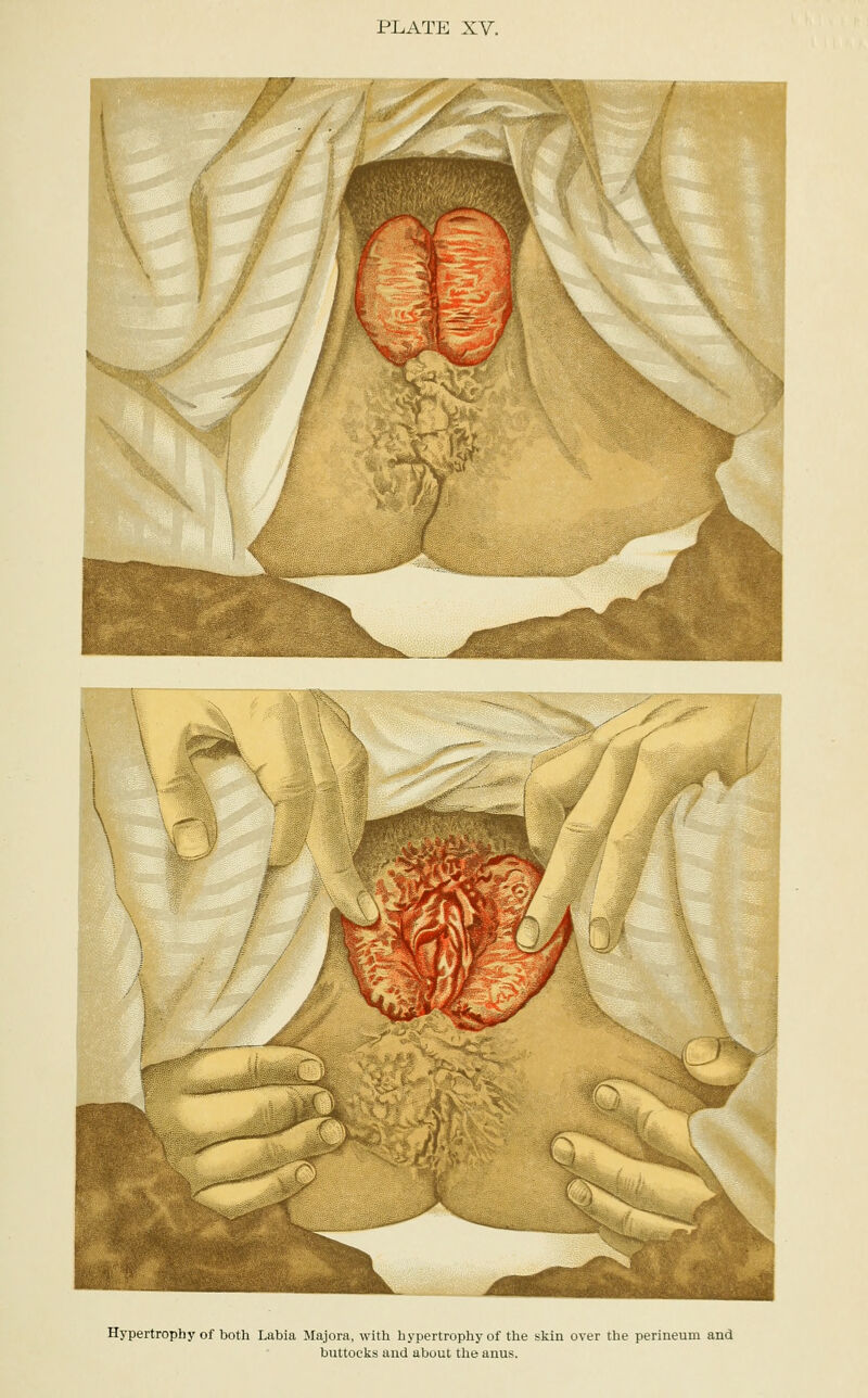 Hypertrophy of both Labia Majora, with hypertrophy of the skin over the perineum and buttocks and about the anus.