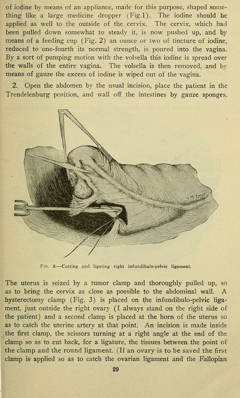 of iodine by means of an appliance, made for this purpose, shaped some- thing like a large medicine dropper (Fig.l). The iodine should be applied as well to the outside of the cervix. The cervix, which had been pulled down somewhat to steady it, is now pushed up, and by means of a feeding cup (Fig. 2) an ounce or two of tincture of iodine, reduced to one-fourth its normal strength, is poured into the vagina. By a sort of pumping motion with the volsella this iodine is spread over the walls of the entire vagina. The volsella is then removed, and by means of gauze the excess of iodine is wiped out of the vagina. 2. Open the abdomen by the usual incision, place the patient in the Trendelenburg position, and wall off the intestines by gauze sponges. Fig. 3.—Cutting and ligating right infundibulo-pelvic ligament. The uterus is seized by a tumor clamp and thoroughly pulled up, so as to bring the cervix as close as possible to the abdominal wall. A hysterectomy clamp (Fig. 3) is placed on the infundibulo-pelvic liga- ment, just outside the right ovary (I always stand on the right side of the patient) and a second clamp is placed at the horn of the uterus so as to catch the uterine artery at that point. An incision is made inside the first clamp, the scissors turning at a right angle at the end of the clamp so as to cut back, for a ligature, the tissues between the point of the clamp and the round ligament. (If an ovary is to be saved the first clamp is applied so as to catch the ovarian ligament and the Fallopian