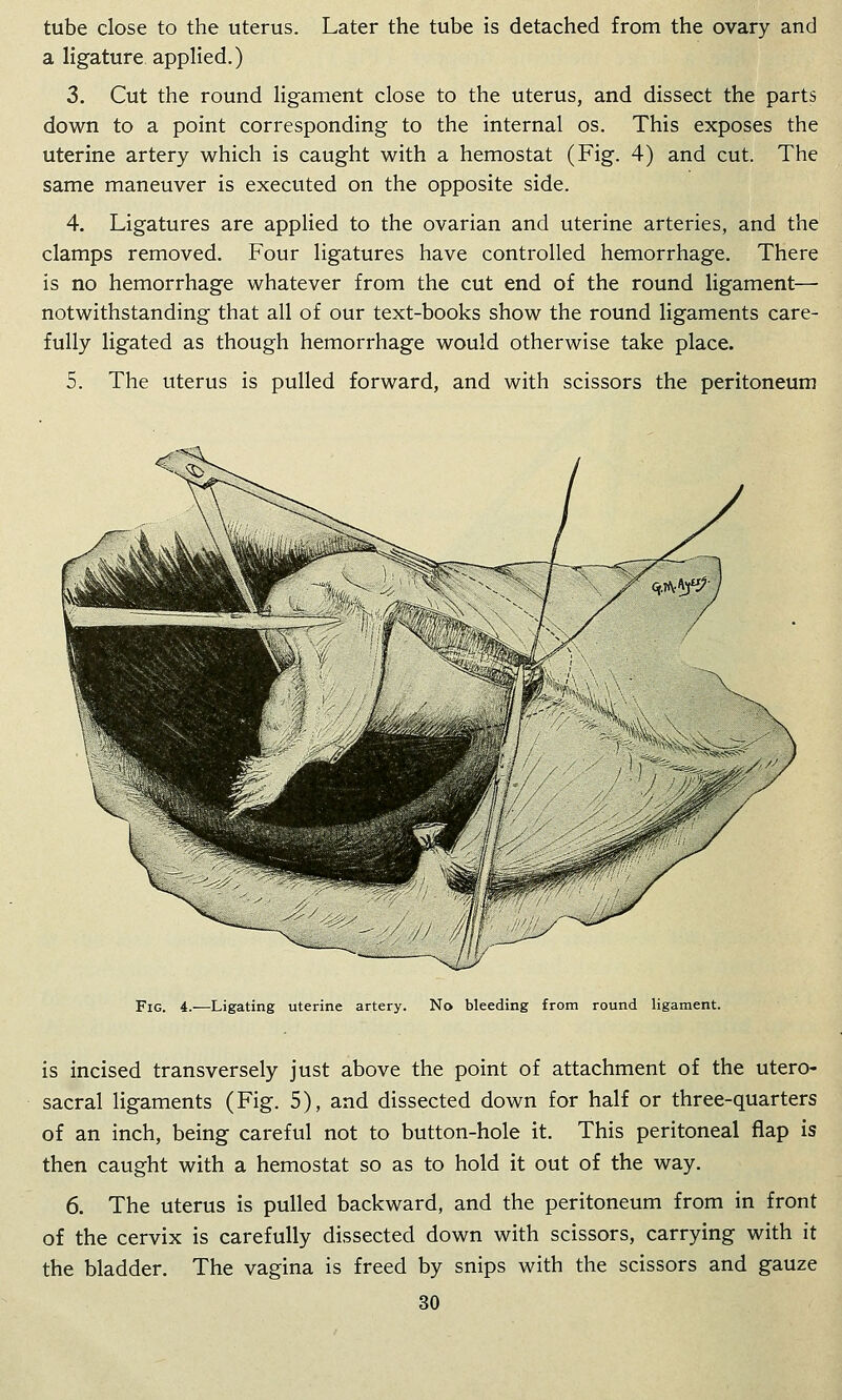 tube close to the uterus. Later the tube is detached from the ovary and a ligature applied.) 3. Cut the round ligament close to the uterus, and dissect the parts down to a point corresponding to the internal os. This exposes the uterine artery which is caught with a hemostat (Fig. 4) and cut. The same maneuver is executed on the opposite side. 4. Ligatures are applied to the ovarian and uterine arteries, and the clamps removed. Four ligatures have controlled hemorrhage. There is no hemorrhage whatever from the cut end of the round ligament— notwithstanding that all of our text-books show the round ligaments care- fully ligated as though hemorrhage would otherwise take place. 5. The uterus is pulled forward, and with scissors the peritoneum Fig. 4.—Ligating uterine artery. No bleeding from round ligament. is incised transversely just above the point of attachment of the utero- sacral ligaments (Fig. 5), and dissected down for half or three-quarters of an inch, being careful not to button-hole it. This peritoneal flap is then caught with a hemostat so as to hold it out of the way. 6. The uterus is pulled backward, and the peritoneum from in front of the cervix is carefully dissected down with scissors, carrying with it the bladder. The vagina is freed by snips with the scissors and gauze