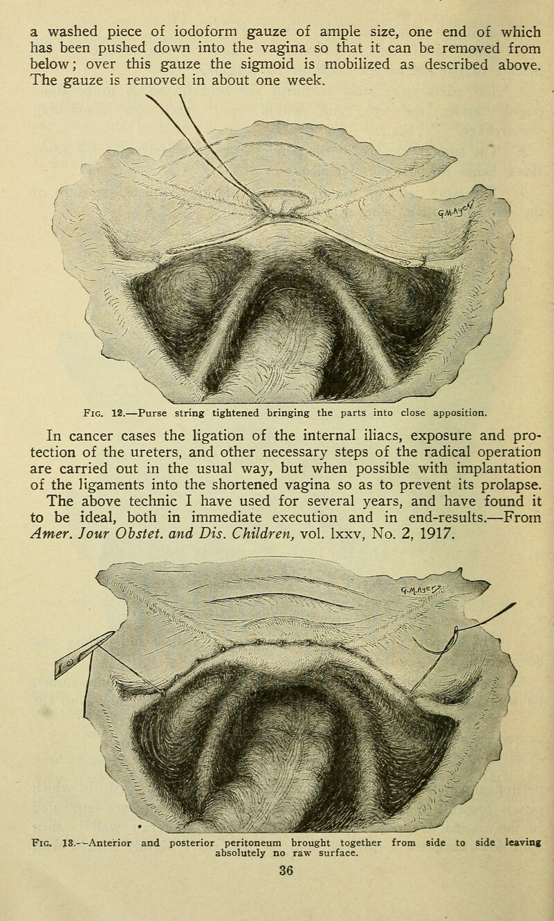 a washed piece of iodoform gauze of ample size, one end of which has been pushed down into the vagina so that it can be removed from below; over this gauze the sigmoid is mobilized as described above. The gauze is removed in about one week. Vv Fig. 12.—Purse string tightened bringing the parts into close apposition. In cancer cases the ligation of the internal iliacs, exposure and pro- tection of the ureters, and other necessary steps of the radical operation are carried out in the usual way, but when possible with implantation of the ligaments into the shortened vagina so as to prevent its prolapse. The above technic I have used for several years, and have found it to be ideal, both in immediate execution and in end-results.—From Amer. Jour Ohstet. and Dis. Children, vol. Ixxv, No. 2, 1917. Fig. 13.-^Anterior and posterior peritoneum brought together from side to side leaving absolutely no raw surface.