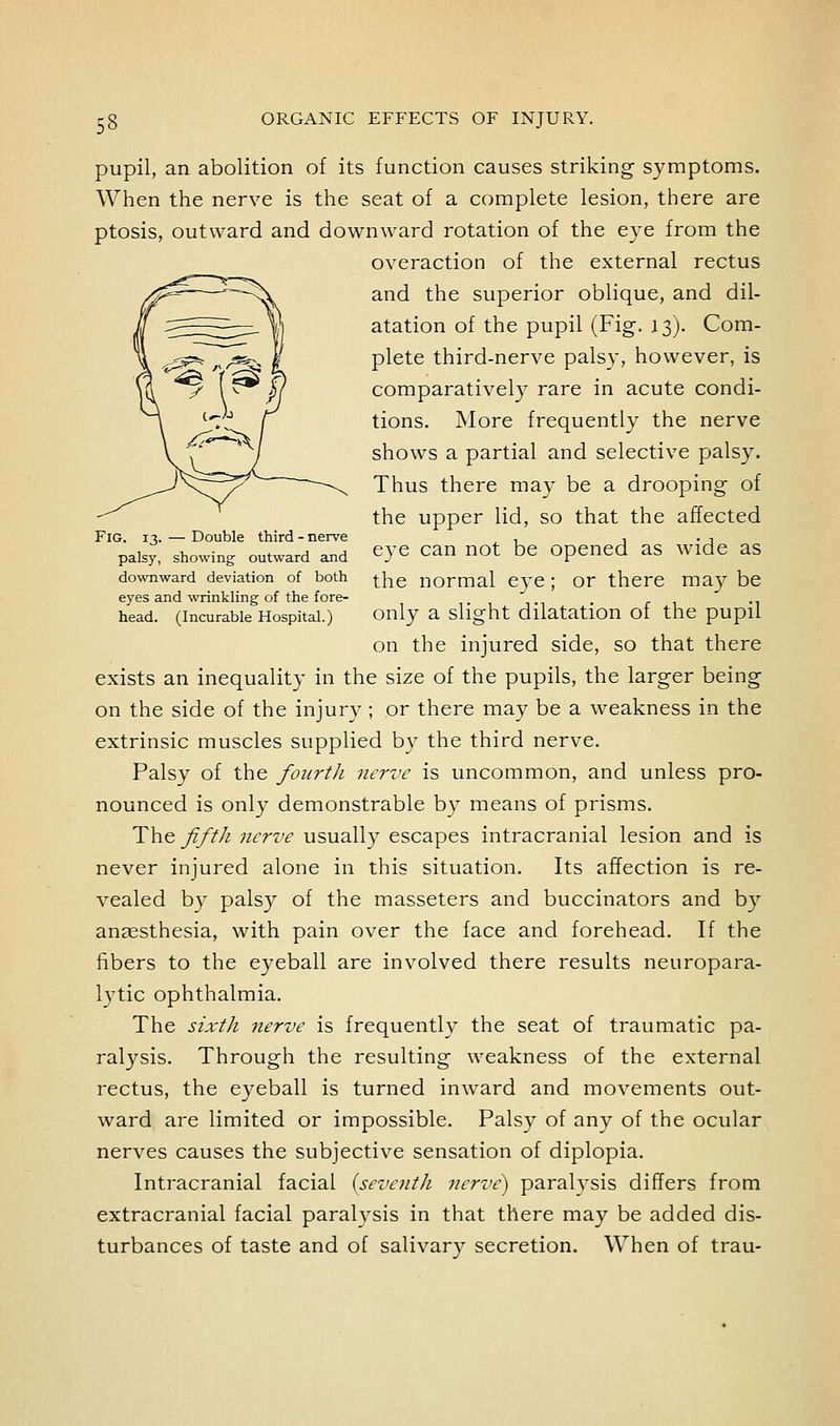 Fig. 13. — Double third - nerve palsy, showing outward and downward deviation of both eyes and wrinkling of the fore- head. (Incurable Hospital.) pupil, an abolition of its function causes striking symptoms. When the nerve is the seat of a complete lesion, there are ptosis, outward and downward rotation of the eye from the overaction of the external rectus and the superior oblique, and dil- atation of the pupil (Fig. 13). Com- plete third-nerve palsy, however, is comparative!}^ rare in acute condi- tions. More frequently the nerve shows a partial and selective palsy. Thus there may be a drooping of the upper lid, so that the affected eye can not be opened as wide as the normal eye; or there maybe only a slight dilatation of the pupil on the injured side, so that there exists an inequality in the size of the pupils, the larger being on the side of the injury; or there may be a weakness in the extrinsic muscles supplied by the third nerve. Palsy of the fourth nerve is uncommon, and unless pro- nounced is only demonstrable by means of prisms. The fifth nerve usually escapes intracranial lesion and is never injured alone in this situation. Its affection is re- vealed by palsy of the masseters and buccinators and by angesthesia, with pain over the face and forehead. If the fibers to the eyeball are involved there results neuropara- lytic ophthalmia. The sixth nerve is frequently the seat of traumatic pa- ralysis. Through the resulting weakness of the external rectus, the eyeball is turned inward and movements out- ward are limited or impossible. Palsy of any of the ocular nerves causes the subjective sensation of diplopia. Intracranial facial {seventh 7ierve) paralysis differs from extracranial facial paralysis in that there may be added dis- turbances of taste and of salivary secretion. When of trau-