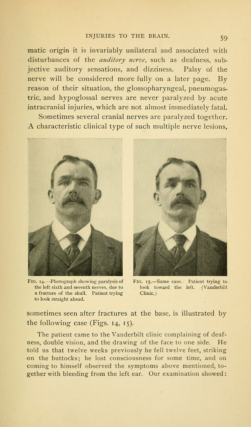 matic origin it is invariably unilateral and associated with disturbances of the auditory 7icrve, such as deafness, sub- jective auditory sensations, and dizziness. Palsy of the nerve will be considered more fully on a later page. By reason of their situation, the glossopharyngeal, pneumogas- tric, and hypoglossal nerves are never paralyzed by acute intracranial injuries, which are not almost immediately fatal. Sometimes several cranial nerves are paralyzed together. A characteristic clinical type of such multiple nerve lesions, TiG. 14.—Photograph showing paralysis of the left sixth and seventh nerves, due to a fracture of the skull. Patient trying to look straight ahead. Fig. 15.—Same case. Patient trying to look toward the left. (Vanderbilt Clinic.) sometimes seen after fractures at the base, is illustrated by the following case (Figs. 14, 15). The patient came to the Vanderbilt clinic complaining of deaf- ness, double vision, and the drawing of the face to one side. He told us that twelve weeks previously he fell twelve feet, striking on the buttocks; he lost consciousness for some time, and on coming to himself observed the symptoms above mentioned, to- gether with bleeding from the left ear. Our examination showed: