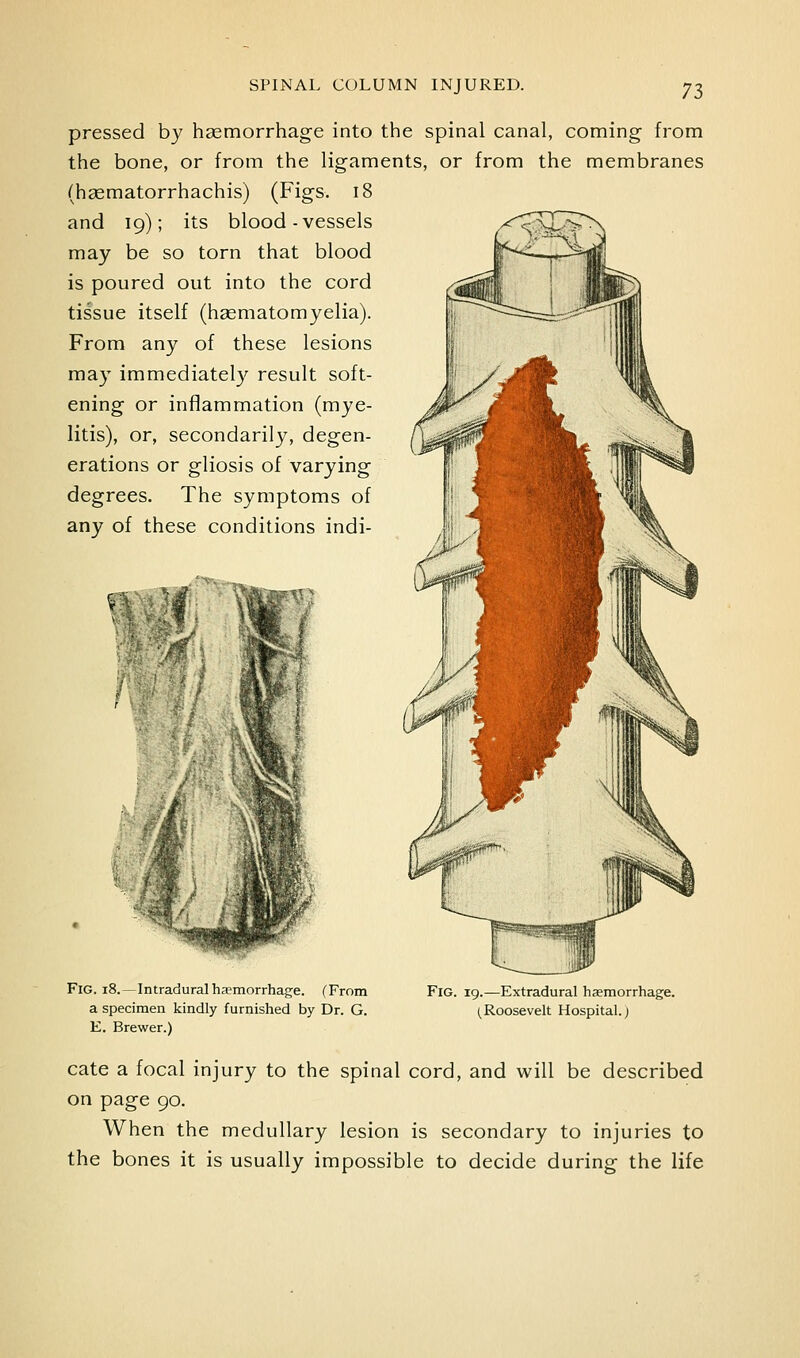 pressed by haemorrhage into the spinal canal, coming from the bone, or from the ligaments, or from the membranes (hsematorrhachis) (Figs. i8 and 19); its blood-vessels may be so torn that blood is poured out into the cord tissue itself (hsematomyelia). From any of these lesions may immediately result soft- ening or inflammation (mye- litis), or, secondarily, degen- erations or gliosis of varying degrees. The symptoms of any of these conditions indi- FlG. 18.—Intradural hsemorrhage. (From a specimen kindly furnished by Dr. G. E. Brewer.) Fig. 19.—Extradural haemorrhage. (Roosevelt Hospital.; cate a focal injury to the spinal cord, and will be described on page 90. When the medullary lesion is secondary to injuries to the bones it is usually impossible to decide during the life