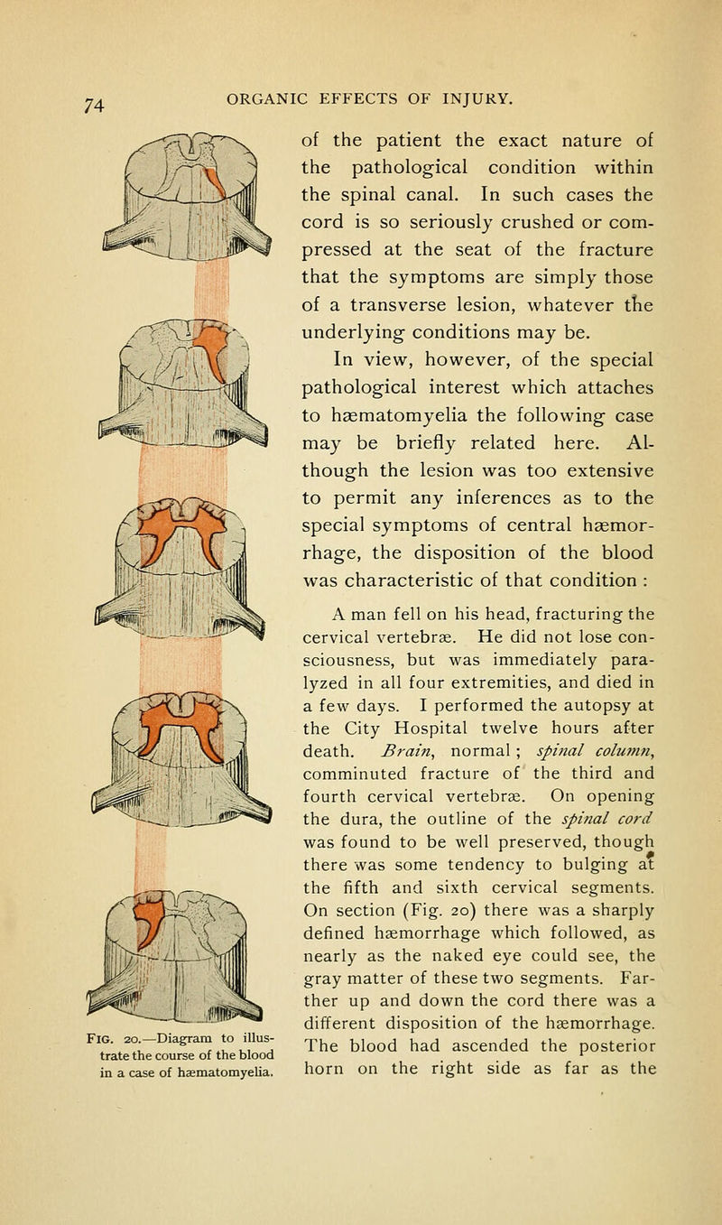 Fig. 20.—Diagram to illus- trate the course of the blood in a case of hasmatomyelia. of the patient the exact nature of the pathological condition within the spinal canal. In such cases the cord is so seriously crushed or com- pressed at the seat of the fracture that the symptoms are simply those of a transverse lesion, whatever tKe underlying conditions may be. In view, however, of the special pathological interest which attaches to hsematomyelia the following case may be briefly related here. Al- though the lesion was too extensive to permit any inferences as to the special symptoms of central haemor- rhage, the disposition of the blood was characteristic of that condition : A man fell on his head, fracturing the cervical vertebrae. He did not lose con- sciousness, but was immediately para- lyzed in all four extremities, and died in a few days. I performed the autopsy at the City Hospital twelve hours after death. Brain, normal ; spinal column, comminuted fracture of the third and fourth cervical vertebrae. On opening the dura, the outline of the spinal cord was found to be well preserved, though there was some tendency to bulging at the fifth and sixth cervical segments. On section (Fig. 20) there was a sharply defined haemorrhage which followed, as nearly as the naked eye could see, the gray matter of these two segments. Far- ther up and down the cord there was a different disposition of the haemorrhage. The blood had ascended the posterior horn on the right side as far as the