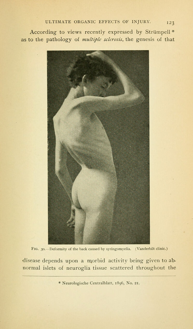 According to views recently expressed by Striimpell * as to the pathology of multiple sclerosis, the genesis of that Fig. 30.—Deformity of the back caused by syringomyelia. (Vanderbilt clinic.) ■disease depends upon a nT.orbid activity being given to ab- normal islets of neuroglia tissue scattered throughout the * Neurologische Centralblatt, 1896, No. 21.