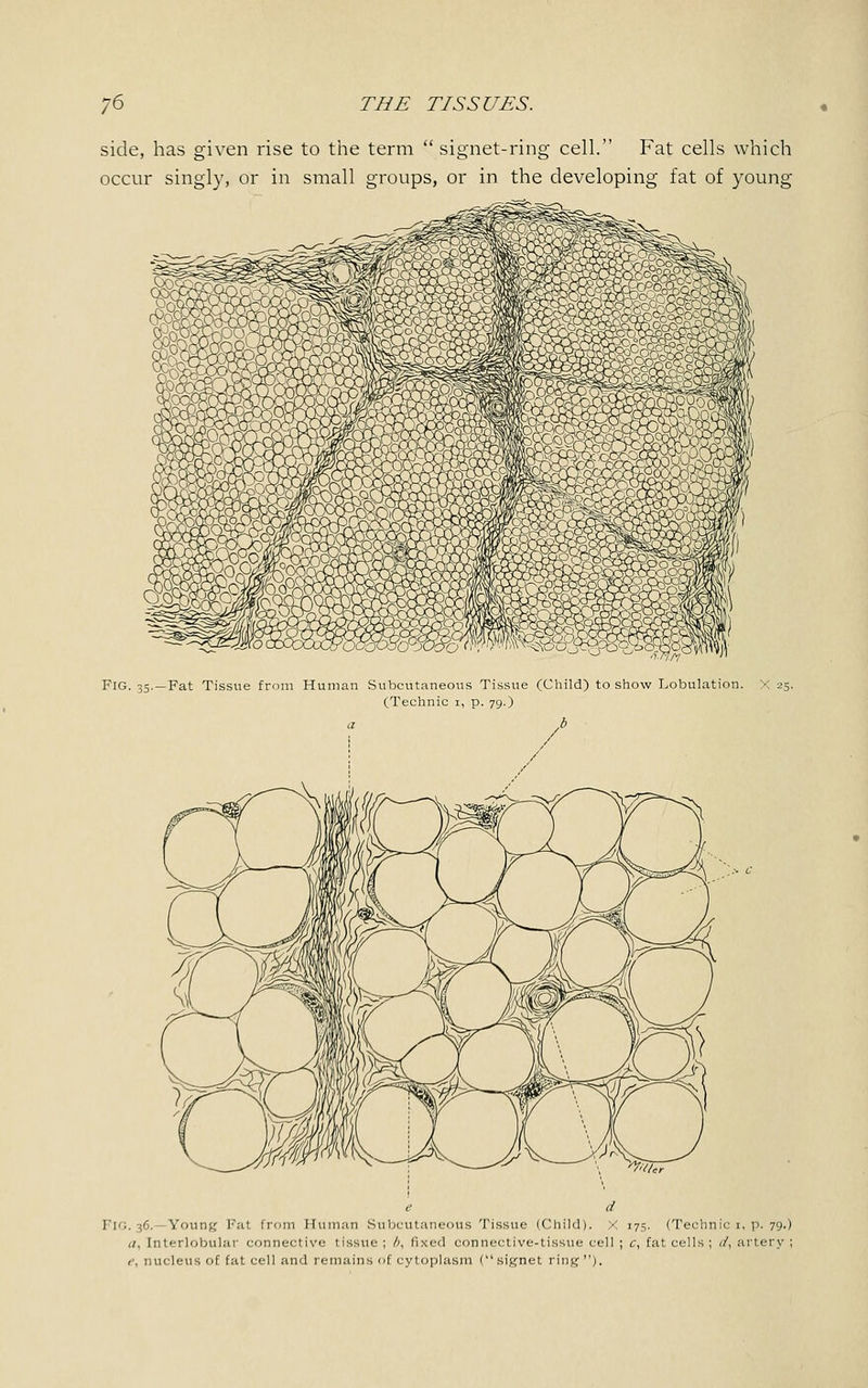 side, has given rise to the term  signet-ring cell. Fat cells which occur singly, or in small groups, or in the developing fat of young Fig. 35.—Fat Tissue from Human Subcutaneous Tissue (Child) to show Lobulation. X 25. (Technic 1, p. 79.) b Young Fat from Human Subcutaneous Tissue (Child). X 175. (Technic r, p. 79.) a. Interlobular connective tissue ; /■>, fixed connective-tissue cell ; c, fat cells; d, artery ; e, nucleus of fat cell and remains of cytoplasm (signet ring').