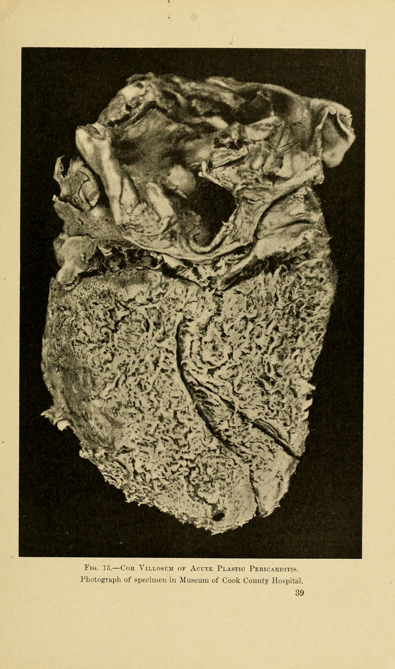 Fig. 13.—Cor Villosum of Acute Plastic Pericarditis. Photograph of specimen in Museum of Cook County Hospital.