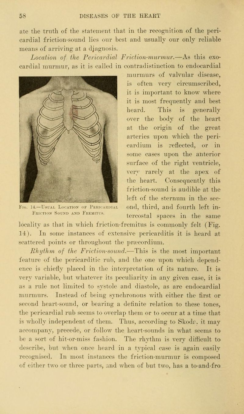 ate the truth of the statement that in the recognition of the peri- cardial friction-sound lies onr best and usually our onlv reliable means of arriving at a djagnosis. Location of the Pericardial Frictioiruiurniur.—As this exo- cardial murmur, as it is called in contradistinction to endocardial murmurs of valvular disease, is often very circumscribed, it is important to know where it is most frequently and best heard. This is generally over the body of the heart at the origin of the great arteries upon which the peri- cardium is reflected, or in some cases upon the anterior surface of the right ventricle, very rarely at the aj^ex of the heart. Consequently this friction-sound is audible at the left of the sternum in the sec- ond, third, and fourth left in- tercostal spaces in the same locality as that in which friction-fremitus is commonly felt (Fig. 14). In some instances of extensive pericarditis it is heard at scattered points or throughout the pra^cordium. Rhythm of the Friction-sound.—This is the most important feature of the pericarditic rul), and the one upon which depend- ence is chiefly placed in the interpretation of its nature. It is very variable, but whatever its peculiarity in any given case, it is as a rule not limited to systole and diastole, as are endocardial murmurs. Instead of being synchronous with either the first or second heart-sound, or bearing a definite relation to these tones, the pericardial rub seems to overlap them or to occur at a time that is wholly independent of them. Thus, according to Skodr. it may accompany, precede, or follow the heart-sounds in what seems to be a sort of hit-or-miss fashion. The rhythm is very difficult to describe, but when (nice heard in a typical case is again easily recognised. In most instances the friction-murmur is composed of either two or tliree parts, and when of but two, has a to-and-fro i4.— L'.-LAi. l^.MAIl't.N Ir i'tlill AlilllAL Friction Sound and Fkemitvs.