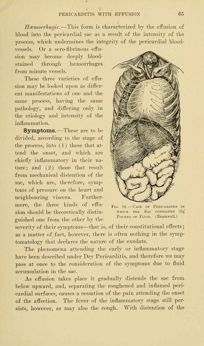 Ilcemorrliagic.—Tliis form is characterized by the effusion of blood into the pericardial sac as a result of the intensity of the process, which undermines the integrity of the pericardial blood- vessels. Or a sero-fibrinous effu- sion may become deeply blood- stained through ha?morrhages from minute vessels. These three varieties of effu- sion may be looked upon as differ- ent manifestations of one and the same process, having the same pathology, and differing only in the etiology and intensity of the inflammation. Symptoms.—These are to be divided, according to the stage of the process, into (1) those that at- tend the onset, and which are chiefly inflammatory in their na- ture; and (2) those that result from mechanical distention of the sac, which are, therefore, symp- toms of pressure on the heart and neighbouring viscera. Further- more, the three kinds of effu- sion should be theoretically distin- guished one from the other by the severity of their symptoms—that is, of their constitutional effects; as a matter of fact, however, there is often nothing in the symp- tomatology that declares the nature of the exudate. The phenomena attending the early or inflammatory stage have been described imder Dry Pericarditis, and therefore we may pass at once to the consideration of the symptoms due to fluid accumulation in the sac. As effusion takes place it gradually distends the sac from below upward, and, separating the roughened and inflamed peri- cardial surfaces, causes a cessation of the pain attending the onset of the affection. The fever of the inflammatory stage still per- sists, however, as may also the cough. With distention of the Fig. 16. — Case of Pericarditis in WHICH THE Sac contained 3j^ Pounds of Fluid. (Brarawell.)