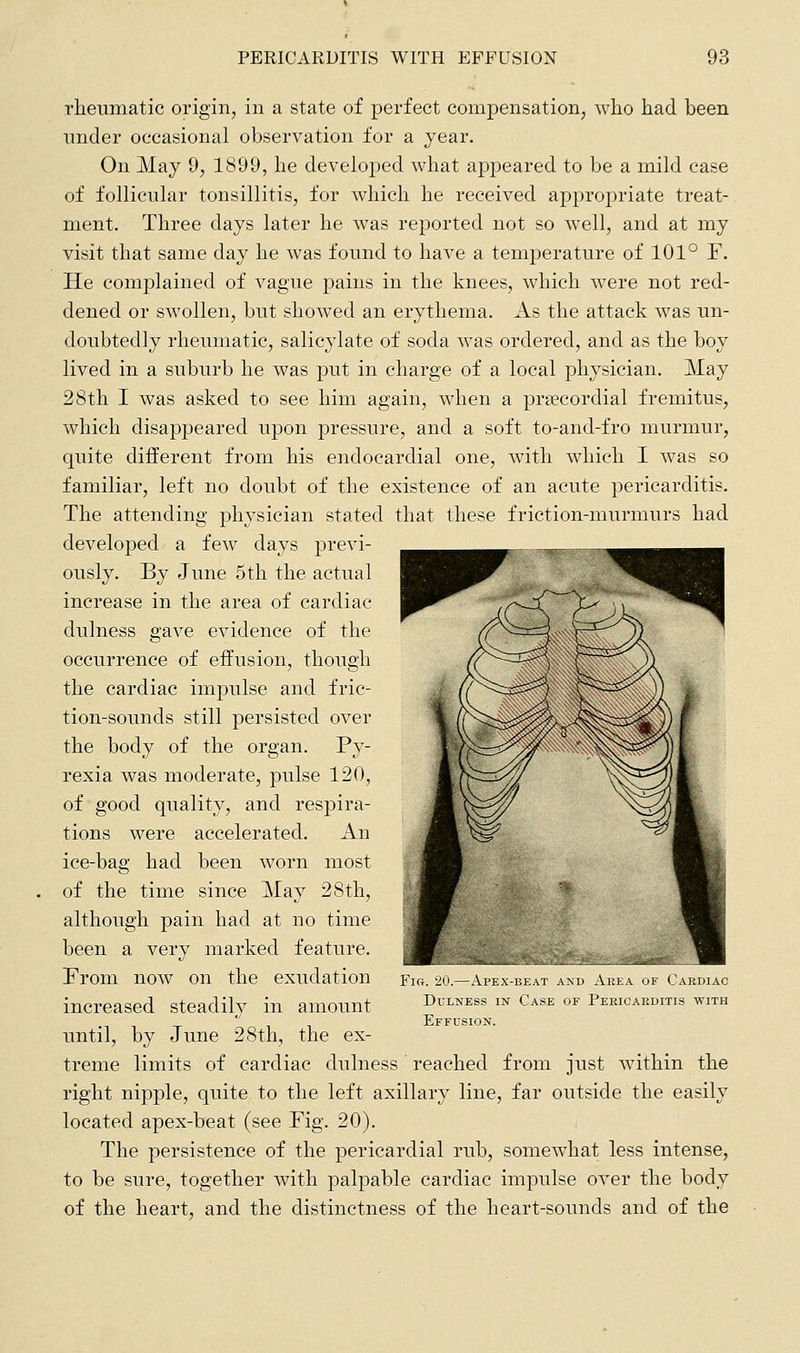 rheumatic origin, in a state of perfect compensation, who had been under occasional observation for a year. On May 9, 1899, he developed what appeared to be a mild case of follicular tonsillitis, for which he received appropriate treat- ment. Three days later he Avas reported not so v^^ell, and at my visit that same day he was found to have a temperature of 101° F. He comjDlained of vague pains in the knees, which were not red- dened or swollen, but showed an erythema. As the attack was un- doubtedly rheumatic, salicylate of soda was ordered, and as the boy lived in a suburb he was put in charge of a local physician. May 28th I was asked to see him again, when a prsecordial fremitus, which disappeared upon pressure, and a soft to-and-fro murmur, quite different from his endocardial one, with which I was so familiar, left no doubt of the existence of an acute pericarditis. The attending ph^^sician stated that these friction-murmurs had developed a few days previ- ously. By June 5th the actual increase in the area of cardiac dulness gave evidence of the occurrence of effusion, though the cardiac impulse and fric- tion-sounds still persisted over the body of the organ. Py- rexia was moderate, pulse 120, of good quality, and respira- tions were accelerated. An ice-bag had been worn most of the time since May 28th, although pain had at no time been a very marked feature. From now on the exudation increased steadily in amount until, by June 28th, the ex- treme limits of cardiac dulness reached from just within the right nipple, quite to the left axillary line, far outside the easily located apex-beat (see Fig. 20). The persistence of the pericardial rub, somewhat less intense, to be sure, together with palpable cardiac impulse over the body of the heart, and the distinctness of the heart-sounds and of the Fig. 20.—Apex-beat and Akea of Cardiac Dulness in Case of Pericarditis with Effusion.