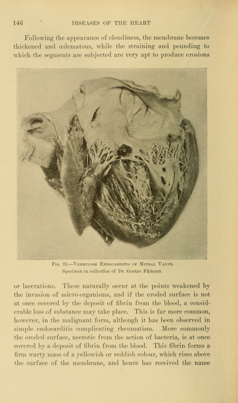 Following the appearance of cloudiness, the membrane becomes thickened and adematoiis, while the straining and pounding to which the seg-ments are subjected are very apt to produce erosions ilP'li Fio. 25.—Verrucose Endocarditis of Mitral Valve. Specimen in collection of Dr. Gustav Fiitterer. or lacerations. These naturally occur at the points weakened by the invasion of micro-organisms, and if tlu^ eroded surface is not at once covered l)y the deposit of tibiin from the blood, a consid- erable loss of substance may take place. This is far more common, however, in the malignant form, although it has been observed in simple endocarditis comi)licating rheunuitism. !More commonly the eroded surface, necrotic fi-om the action of bacteria, is at once covered by a de]X)sit of fibrin from the blood. This fibrin forms a firm warty mass of a yellowish or reddish colour, which rises above the surface of the membrane, and hence has received the name