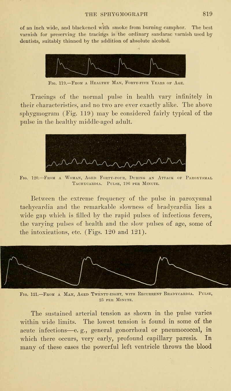 of an inch wide, and blackened with smoke from burning camphor. The best varnish for preserving the tracirfgs is the ordinary sandarac varnish used by dentists, suitably thinned by the addition of absolute alcohol. Fig. 119.—From a IIealtiiy Man, Forty-five Years of Age. Tracings of the normal pnlse in health vary infinitely in their characteristics, and no two are ever exactly alike. The above sphygmogram (Fig. 119) may be considerecl fairly typical of the pulse in the healthy middle-aged adult. Fig. 120.—-From a Womaw, Aged Forty-four, During an Attack of Paroxysmal Tachycardia. Pulse, 196 per Minute. Between the extreme frequency of the pulse in paroxysmal tachycardia and the remarkable slowness of bradycardia lies a wide gap which is filled by the rapid pulses of infectious fevers, the varying pulses of health and the slow pulses of age, some of the intoxications, etc. (Figs. 120 and 121). Fig. 121.—From a Man, Aged Twenty-eight, -with Eecuerent Bradycardia. Pulse, 25 per Minute. The sustained arterial tension as shown in the pulse varies within wide limits. The lowest tension is found in some of the acute infections—e. g., general gonorrhoeal or pneumococcal, in which there occurs, very early, profound capillary paresis. In many of these cases the powerful left ventricle throws the blood