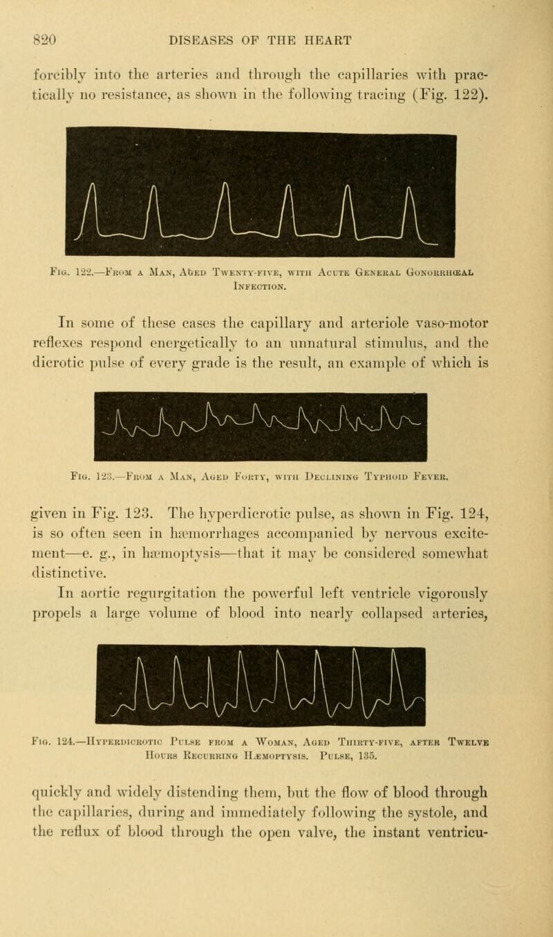 forcibly into the arteries and tlirouiili the capillaries with prac- tically no resistance, as shown in the following tracing (Fig. 122). Fig. 12i!.—Fkum a Man, AbEu Tweniy-five, with Acute Genekal Gonouuhceal Infection. In some of these cases the capillary and arteriole vaso-motor reflexes respond energetically to an nnnatnral stinmlns, and the dicrotic pnlse of every grade is the result, an example of which is Fig. l2o.—FuoM a Man, Aukd Foinv, with Declining Tvimiuid Fever. given in Fig. 123. The hyperdicrotic pnlse, as shown in Fig. 124, is so often seen in ha?morrhages accompanied by nervous excite- ment—e. g., in ha?moptysis—that it may be considered somewhat distinctive. In aortic regurgitation the po^verful left ventricle vigorously propels a large volume of blood into nearly collapsed arteries, Fig. 124.—liyrEKDiuKoxic Fllue fkom a Woman, Aoeu Tiiiuty-kive, aktek Twelve Hours Kecurkino ILemoptvsis. Pulse, 135. quickly and Avidely distending tlieni, but the flow of blood through the capillaries, during and immediately following the systole, and the reflux of blood through the open valve, the instant ventricu-