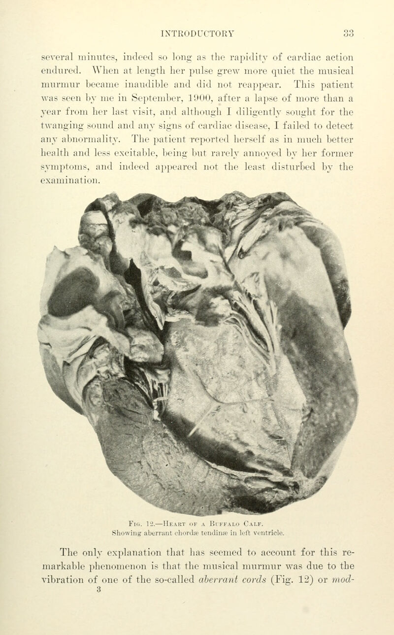several minutes, indeed so long as the rapidity of cardiac action endnred. When at length her pulse grew more quiet the musical murmur became inaudible and did not reappear. This patient was seen by me in September, lUOO, after a lapse of more than a year from her last visit, and although I diligently sought for the twanging sound and any signs of cardiac disease, I failed to detect any abnormality. The patient reported herself as in much better health and less excitable, being but rarely annoyed by her former symptoms, and indeed appeared not the least disturbed by the examination. Fig. \2.—IIeaki ^.i \ Hi ffalo Calf. Showing aberrant chorda.' tcndiniv in lol't vt-ntricle. The only explanation that has seemed to account for this re- markable 2)henomenon is that the musical murmur was due to the vibration of one of the so-called aberrant cords (Fig. 12) or mod-