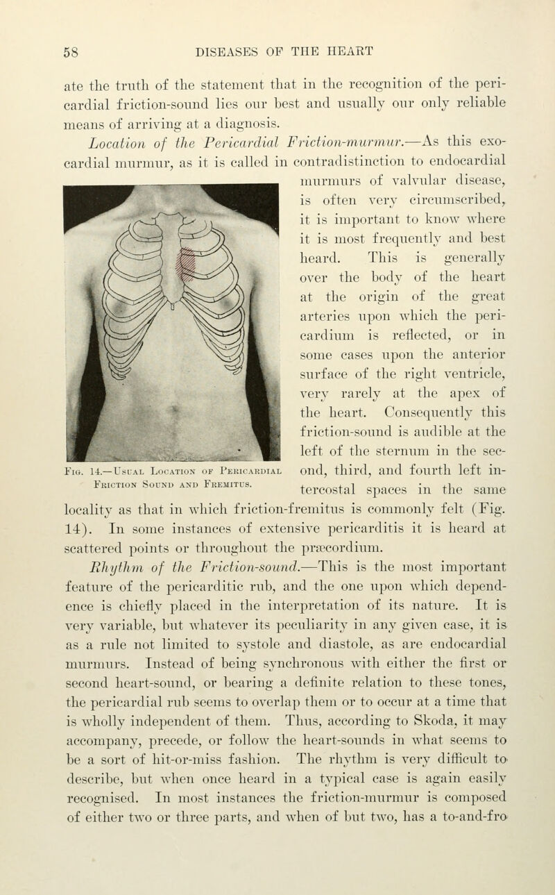 ate the truth of the statement that in the recognition of the peri- cardial friction-sound lies our best and usually our only reliable means of arriving at a diagnosis. Location of the Pericardial Friction-murmur.—As this exo- cardial murmur, as it is called in contradistinction to endocardial murmurs of valvular disease, is often very circumscribed, it is important to know where it is most frequently and best heard. This is generally over the body of the heart at the origin of the great arteries upon which the peri- cardium is reflected, or in some cases upon the anterior surface of the right ventricle, very rarely at the apex of the heart. Consequently this friction-sound is audible at the left of the sternum in the sec- ond, third, and fourth left in- tercostal spaces in the same locality as that in which friction-fremitus is commonly felt (Fig. 14). In some instances of extensive pericarditis it is heard at scattered points or throughout the pripcordium. Rhythm of the Friction-sound.—This is the most important feature of the pericarditic rub, and the one upon which depend- ence is chiefly placed in the interpretation of its nature. It is very variable, but whatever its peculiarity in any given case, it is as a rule not limited to systole and diastole, as are endocardial murmurs. Instead of being synchronous with either the first or second heart-sound, or bearing a definite relation to these tones, the pericardial rub seems to overlap them or to occur at a time that is wholly independent of them. Thus, according to Skoda, it may accompany, precede, or follow the heart-sounds in what seems to be a sort of hit-or-miss fashion. The rhythm is very difficult tO' describe, but when once heard in a typical case is again easily recognised. In most instances the friction-murmur is composed of either two or three parts, and when of but two, has a to-and-fro Fig. 14.—Usual Ijh atkin i l'i,i:ii akdial Friction Sound and Fkemitus,