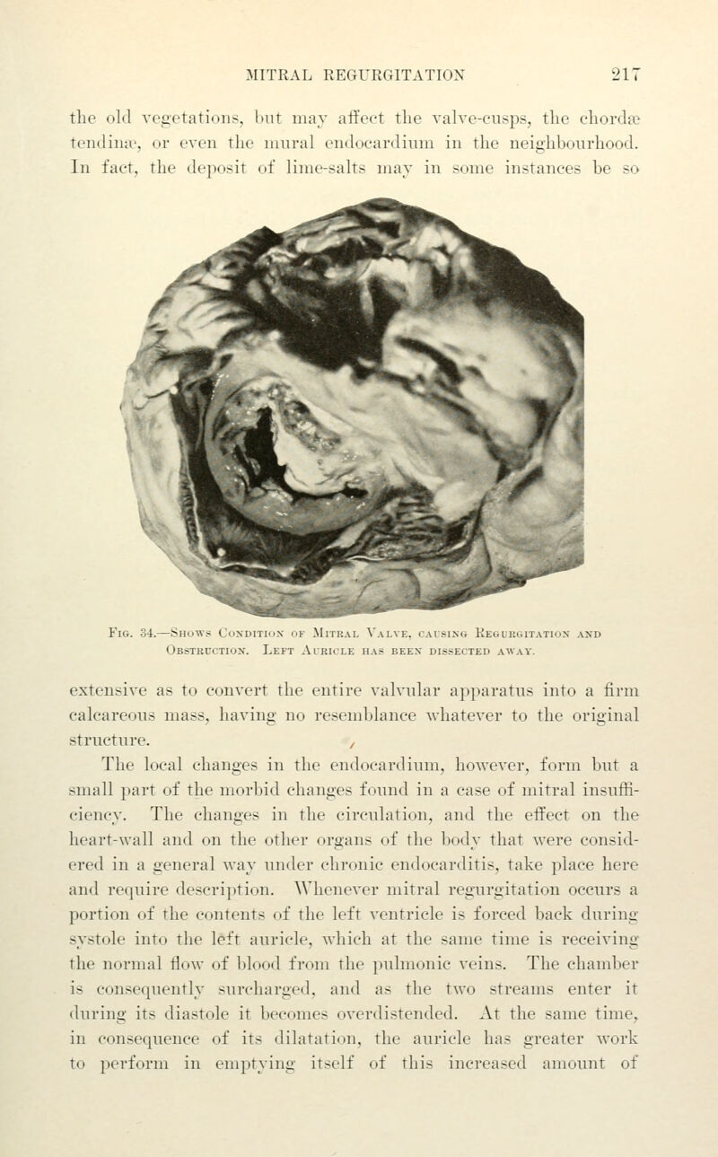 the old veii'etations, Imt may aft'eet the valvc-ciisps, the chorda? tendiiue, or even the mural endocardium in the neighbourhood. In fact, the deposit of lime-salts may in some instances be so Fig. 34.—Shows Condition of Mitral \'alve, causing Keguegitatiox and Obstkuction. Left Auricle has been dissected away. extensive as to convert the entire valvular apparatus into a firm calcareous mass, having no resemblance whatever to the original structure. , The local changes in the endocardium, hoAvever, form but a small part of the morbid changes found in a case of mitral insuffi- ciency. The changes in the circulation, and the effect on the heart-wall and on the other organs of the body that were consid- ered in a general way under chronic endocarditis, take place here and require description. Whenever mitral regurgitation occurs a portion of the contents of the left ventricle is forced back during systole into the left auricle, which at the same time is receiving the normal flow of blood from the pulmonic veins. The chamber is consequently surcharged, and as the two streams enter it during its diastole it becomes overdistended. At the same time, in consequence of its dilatation, the auricle has greater work to perform in emptying itself of this increased amount of