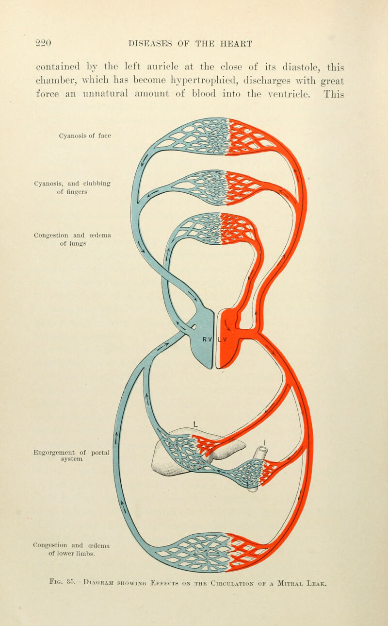 contained l»_v tlic left anriele at the close of its diastole, this chamber, which has become hypertrophied, discharges with great force an unnatural amount of blood into the ventricle. This Cyanosis of face Cyanosis, and clubbing of fingers Congestion and cedcma of lungs \\\ Engorgement of portal system Congestion and oedema of lower limbs. Fig. 35.—Diagram showing Effects on the Circulation of a Mitral Leak.