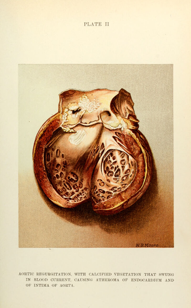 PLATE II M&Ho.oi:^yi^ AORTIC EEGURGITATIOX, WITH CALCIFIED VEGETATION THAT SWUNG IN BLOOD CURRENT, CAUSING ATHEROMA OF ENDOCARDIUM AND OF INTIMA OF AORTA.