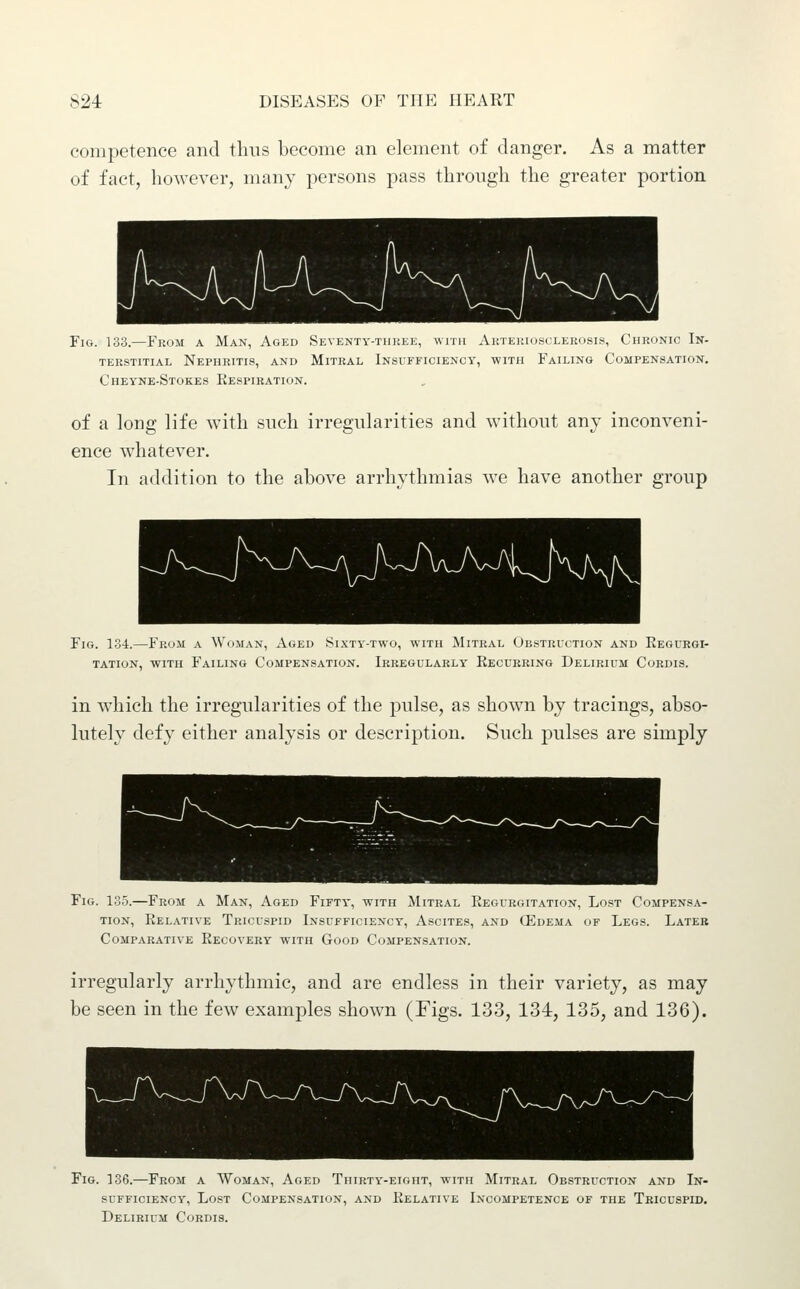 competence and thus become an element of danger. As a matter of fact, however, many persons pass through the greater portion Fig. 133.—From a Man, Aged Seventy-tiu{ee, with Aktehiosclerosis, Chronic In- terstitial Nephritis, and Mitral Insufficiency, with Failing Compensation. Cheyne-Stokes Respiration. of a long life with such irregularities and without any inconveni- ence whatever. In addition to the above arrhythmias we have another group Fig. 134.—From a Wuman, Ai.eu Sixty-two, with Mitral Obstruction and Eegurgi- TATioN, with Failing Compensation. Irregularly Recurring Delirium Cordis. in which the irregularities of the pulse, as shown by tracings, abso- lutely defy either analysis or description. Such pulses are simply Fig. 135.—From a Man, Aged Fifty, with Mitral Regurgitation, Lost Compensa- tion, Relative Tricuspid Insufficiency, Ascites, and CEdema of Legs. Later Comparative Recovery with Good Compensation. irregularly arrhythmic, and are endless in their variety, as may be seen in the few examples shown (Figs. 133, 134, 135, and 136). Fig. 136.—From a Woman, Aged Thirty-eight, with Mitral OBSTRurjioN and In- sufficiency, Lost Compensation, and Relative Incompetence of the Tricuspid. Delirium Cordis.