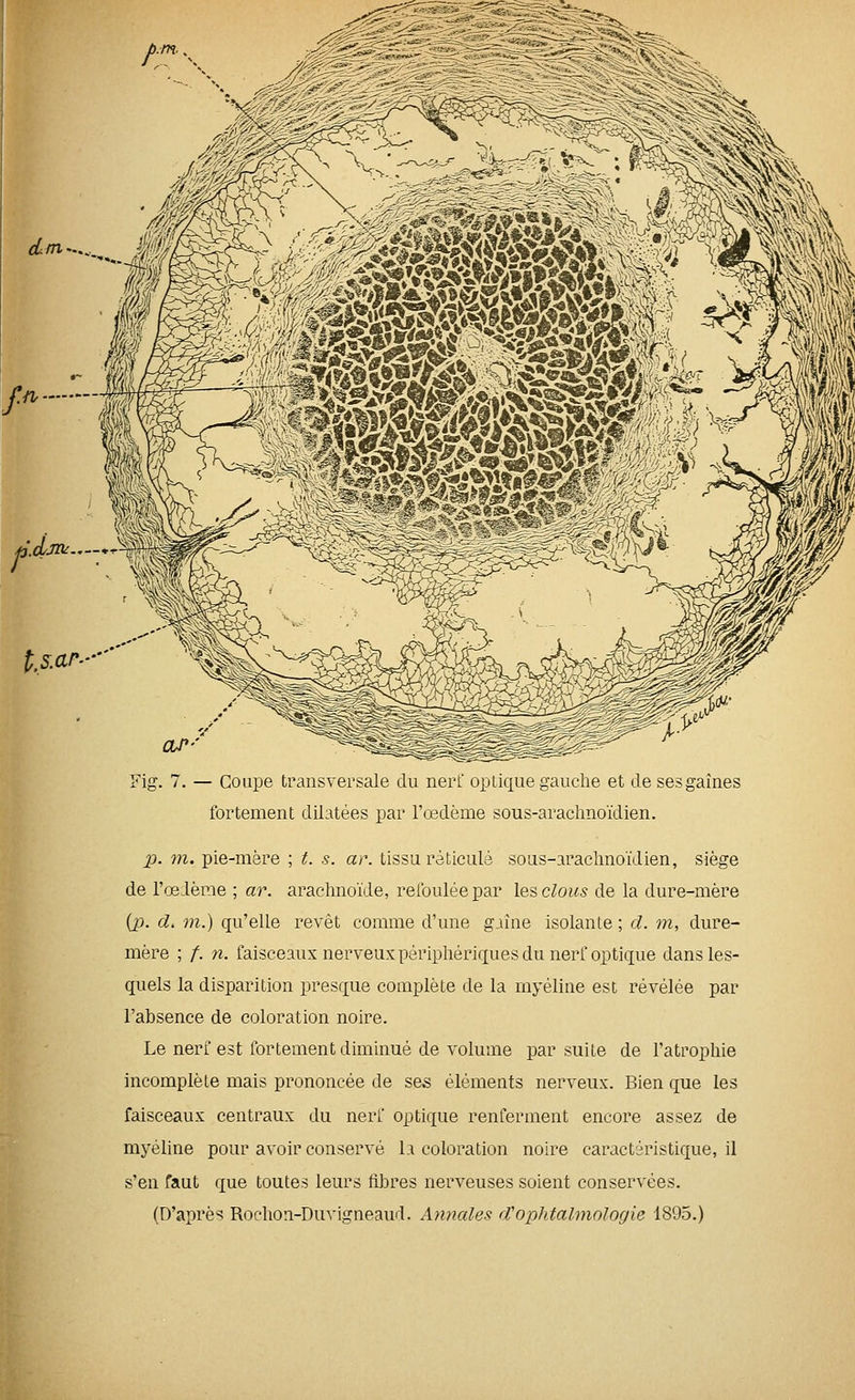 CÙM'.,, f.n f J/JO^- t.s.ar-' Fig. 7. — Coupe transversale du nerf optique gauche et desesgaînes fortement dilatées par l'œdème sous-arachnoïdien. p. 7)1. pie-mère ; t. s. ar. tissu réticulé sous-arachnoïdien, siège de l'œdème ; ar. arachnoïde, refoulée par les clous de la dure-mère {p. d. m.) qu'elle revêt comme d'une gaine isolante ; cl. m, dure- mère ; /. n. faisceaux nerveux périphériques du nerf optique dans les- quels la disparition presque complète de la myéline est révélée par l'absence de coloration noire. Le nerf est fortement diminué de volume par suite de l'atrophie incomplète mais prononcée de ses éléments nerveux. Bien que les faisceaux centraux du nerf optique renferment encore assez de myéline pour avoir conservé 1a coloration noire caractéristique, il s'en faut que toutes leurs flbres nerveuses soient conservées. (D'après Rochon-Du^'igneaud. Annales d'ophtalmologie 1895.)