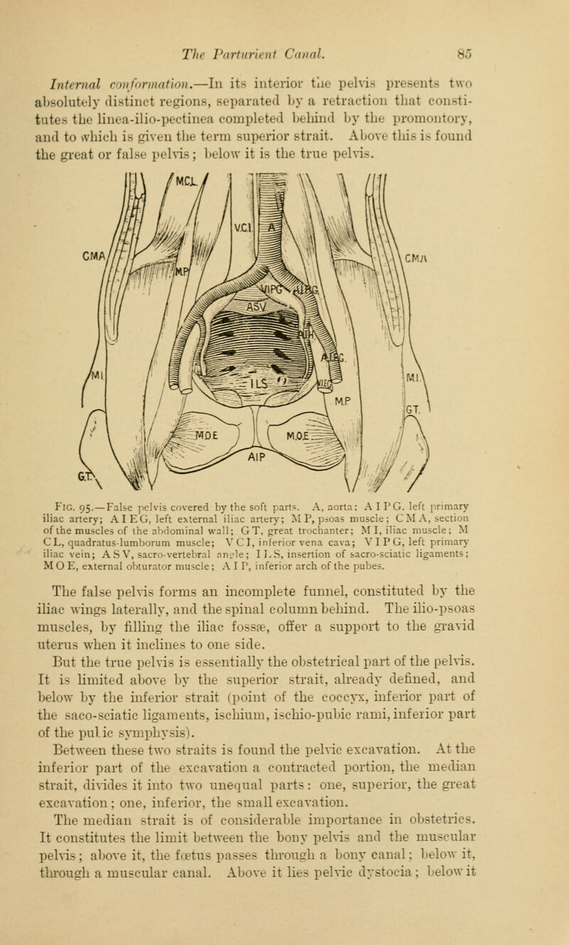 Internal conformation.—In it- interior tlie pelvis presents two absolutely distinct regions, separated by a retraction that consti- tutes the linea-ilio-pectinea completed behind by the promontory, and to which is given the term superior strait. Above this is found the great or false pelvis; below it is the true pelvis. Fig. 95.—False pelvis covered by the soft parts. A, aorta: A I PG, left primary iliac artery; A I EG, left external iliac artery; M P, psoas muscle; CM A, section of the muscles of the abdominal wall; GT, great trochanter; MI, iliac muscle; M CL, quadratus-lumborum muscle; V C I, inferior vena cava; VI PG, left primary iliac vein; ASV, sacro-vertebral nn^'le; 11.8, insertion of sacro-sciatic ligaments; MO E, external obturator muscle; A I P, inferior arch of the pubes. The false pelvis forms an incomplete funnel, constituted by the iliac wings laterally, and the spinal column behind. The ilio-psoas muscles, by filling the iliac fossa?, offer a support to the gravid uterus when it inclines to one side. But the true pelvis is essentially the obstetrical part of the pelvis. It is limited above by the superior strait, already defined, and below by the inferior strait (point of the coccyx, inferior part of the saco-sciatic ligaments, ischium, ischio-pubic rami, inferior part of the pulic symphysis). Between these two straits is found the pelvic excavation. At the inferior part of the excavation a contracted portion, the median strait, divides it into two unequal parts: one, superior, the great excavation; one, inferior, the small excavation. The median strait is of considerable importance in obstetrics. It constitutes the limit between the bony pelvis and the muscular pelvis; above it, the foetus passes through a bony canal; below it, through a muscular canal. Above it lies pelvic dystocia: below it