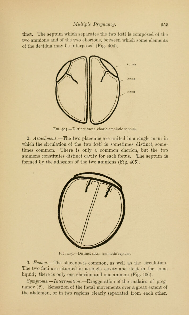 tinct. The .septum which separates the two fceti is composed of the two amnion- ami of the two chorions, between which some elements of the decidua may be interposed (Fig. 404). Fig. 404.—Distinct sacs: chorio-amniotic septum. 2. Attachment.—The two placentae are united in a single mas 1 in winch the circulation of the two fceti is sometimes distinct, some- times common. There is only a common chorion, but the two amnions constitutes distinct cavity for each foetus. The septum is formed by the adhesion of the two amnions (Fig. 405). Fig. 405.—Distinct sacs: amniotic septum. 3. Fusion.—The placenta is common, as well as the circulation. The two fceti are situated in a single cavity and float in the same liquid; there is only one chorion and one amnion (Fig. 406). Symptoms.—Interrogation.—Exaggeration of the malaise of preg- nancy (?). Sensation of the foetal movements over a great extent of the abdomen, or in two regions clearly separated from each other.