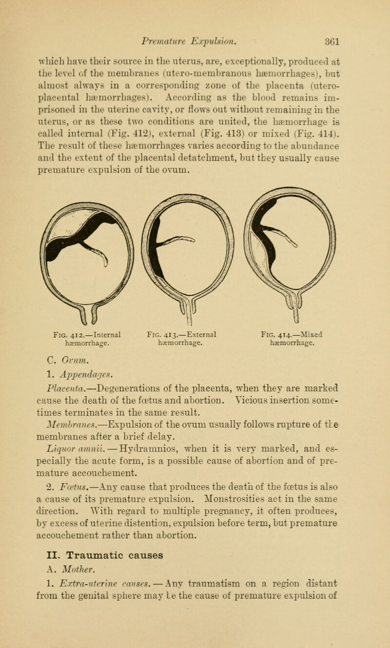 which have their source in the uterus, are, exceptionally, produced at the level of the membranes (ut< ro-membranoua hemorrhages), but almost always in a corresponding zone of the placenta (utero- placental hemorrhages). According as the blood remains im- prisoned in the uterine cavity, or flows out without remaining in the uterus, or as these two conditions are united, the hemorrhage is called internal (Fig. 412), external (Fig. 413) or mixed (Fig. 414). The result of these hemorrhages varies according to the abundance and the extent of the placental detatchment, hut they usually cause premature expulsion of the ovum. Fig. 412.—Internal haemorrhage. Fig. 413.—External haemorrhage. Fig. 414.—Mixed haemorrhage. C. Ovum. 1. Appendages. Placenta.—Degenerations of the placenta, when they are marked cause the death of the foetus and abortion. Vicious insertion some- times terminates in the same result. Membranes.—Expulsion of the ovum usually follows rupture of tie membranes after a brief delay. Liquor amnii.—Hydramnios, when it is very marked, and es- pecially the acute form, is a possible cause of abortion and of pre- mature accouchement. 2. Foetus,—Any cause that produces the death of the fcetus is also a cause of its premature expulsion. Monstrosities act in the same direction. With regard to multiple pregnancy, it often produces, by excess of uterine distention, expulsion before term, but premature accouchement rather than abortion. II. Traumatic causes A. Mother. 1. Extra-uterine causes. — Any traumatism on a region distant from the genital sphere may Le the cause of premature expulsion of