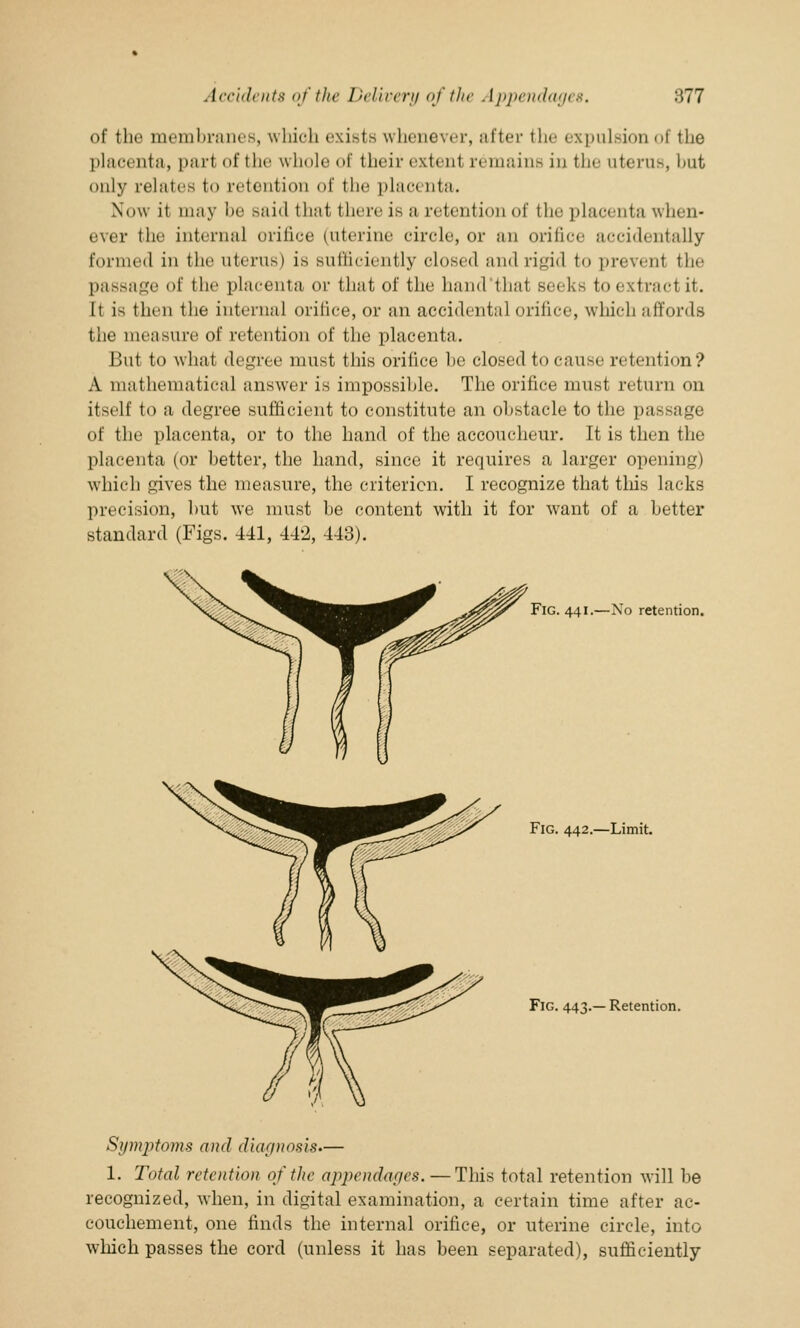 of th«' nu'inlinuK's, which exists whenever, after the expulsion of the placenta, part of the whole of their extent renin in:- in the uterus, hut only relates to retention of the placenta. Now it may be Baid that there is a retention of the placenta when- ever the internal orifice (uterine circle, or an orifice accidentally formed in the uterus) is sufficiently dosed and rigid to prevenl the passage of the placenta or that of the hand thai seeke to extract it. It is then the internal orifice, or an accidental orifice, which affords the measure of retention of the placenta. But to what degree must this orifice he closed to cause retention? A mathematical answer is impossible. The orifice must return on itself to a degree sufficient to constitute an obstacle to the passage of the placenta, or to the hand of the accoucheur. It is then the placenta (or better, the hand, since it requires a larger opening) which gives the measure, the criterion. I recognize that this lacks precision, hut we must he content with it for want of a better standard (Figs. 441, 442, 443). Fig. 441.—No retention. Fig. 442.—Limit. Fig. 443.— Retention. Symjitoms and diagnosis.— 1. Total retention of the appendages. —This total retention will be recognized, when, in digital examination, a certain time after ac- couchement, one finds the internal orifice, or uterine circle, into which passes the cord (unless it has been separated), sufficiently