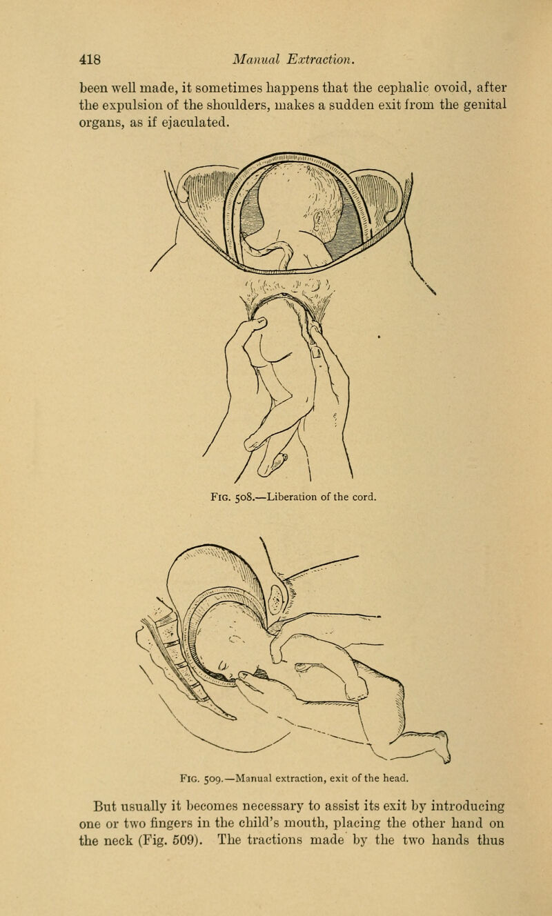 been well made, it sometimes happens that the cephalic ovoid, after the expulsion of the shoulders, makes a sudden exit from the genital organs, as if ejaculated. Fig. 508.—Liberation of the cord. Fig. 509.—Manual extraction, exit of the head. But usually it becomes necessary to assist its exit by introducing one or two fingers in the child's mouth, placing the other hand on the neck (Fig. 509). The tractions made by the two hands thus