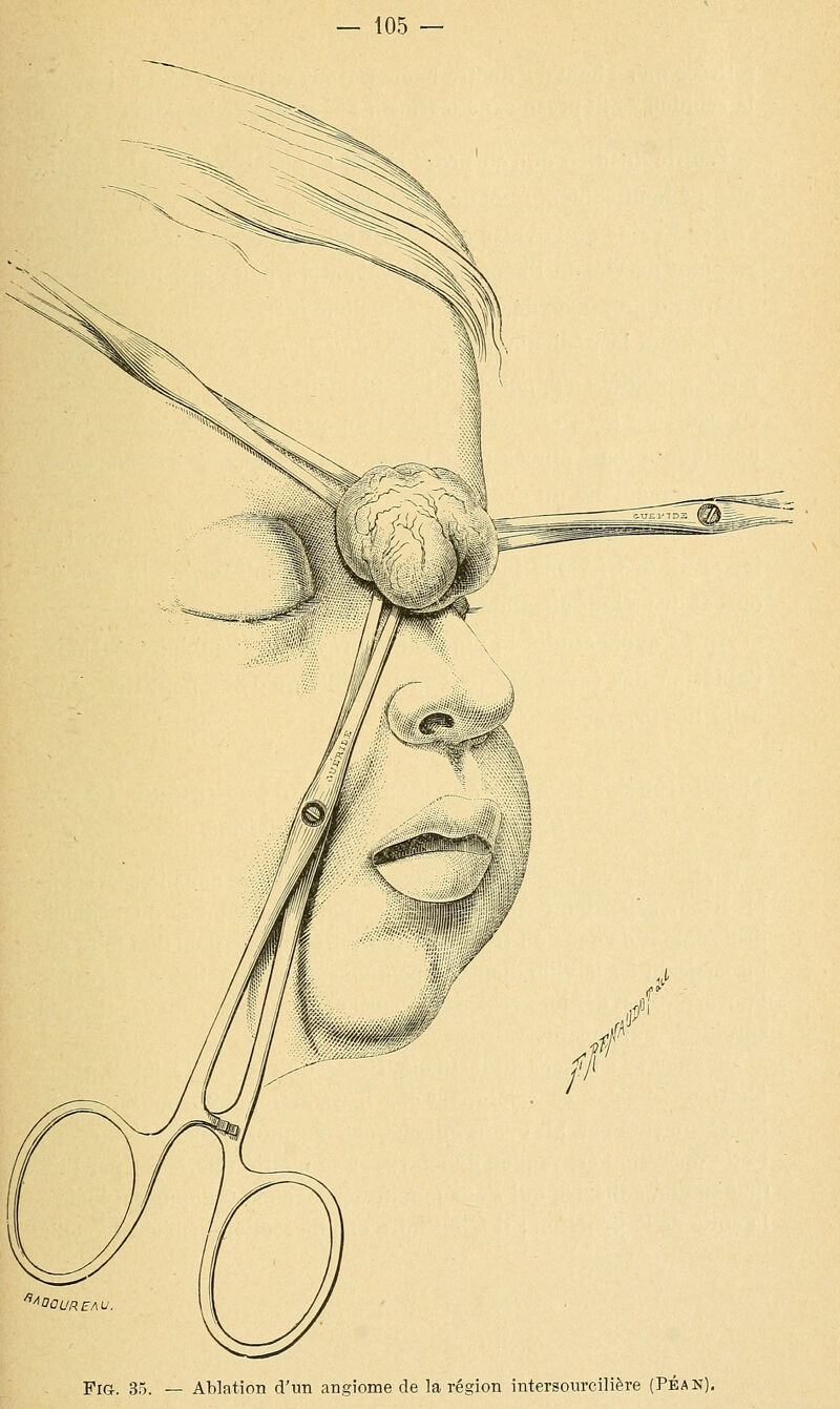 *AOOUREAU FiG. 35. — Ablation d'un angiome de la région intersourcilière (Pbak)