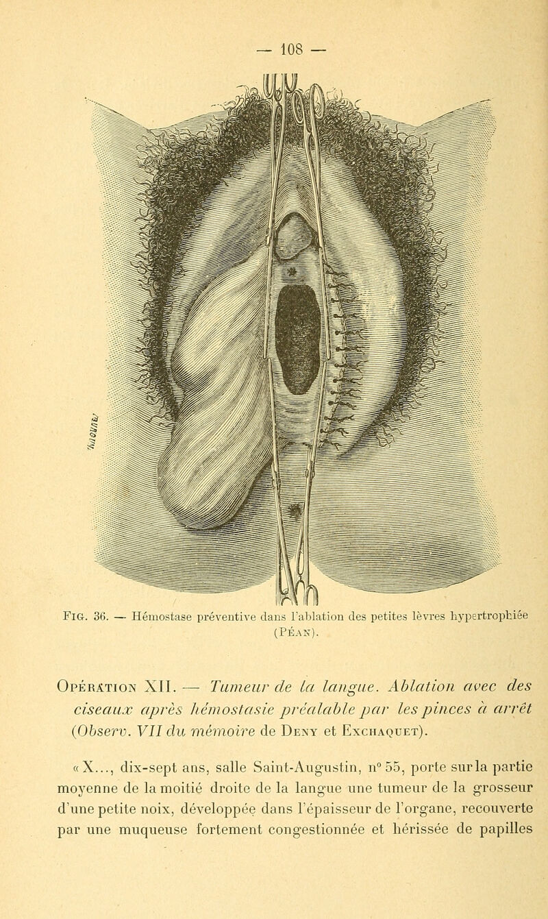 Fig. 36. — Hémostase préventive dans l'ablation des petites lèvres hypertrophiée (PÉAK). Opération XII. —- Tumeur de la langue. Ablation avec des ciseaux après hémostasie préalable par les pinces à arrêt (Observ. VII du mémoire de Deny et Exchaquet). «X..., dix-sept ans, salle Saint-Augustin, n°55, porte sur la partie moyenne de la moitié droite de la langue une tumeur de la grosseur d'une petite noix, développée dans l'épaisseur de l'organe, recouverte par une muqueuse fortement congestionnée et hérissée de papilles