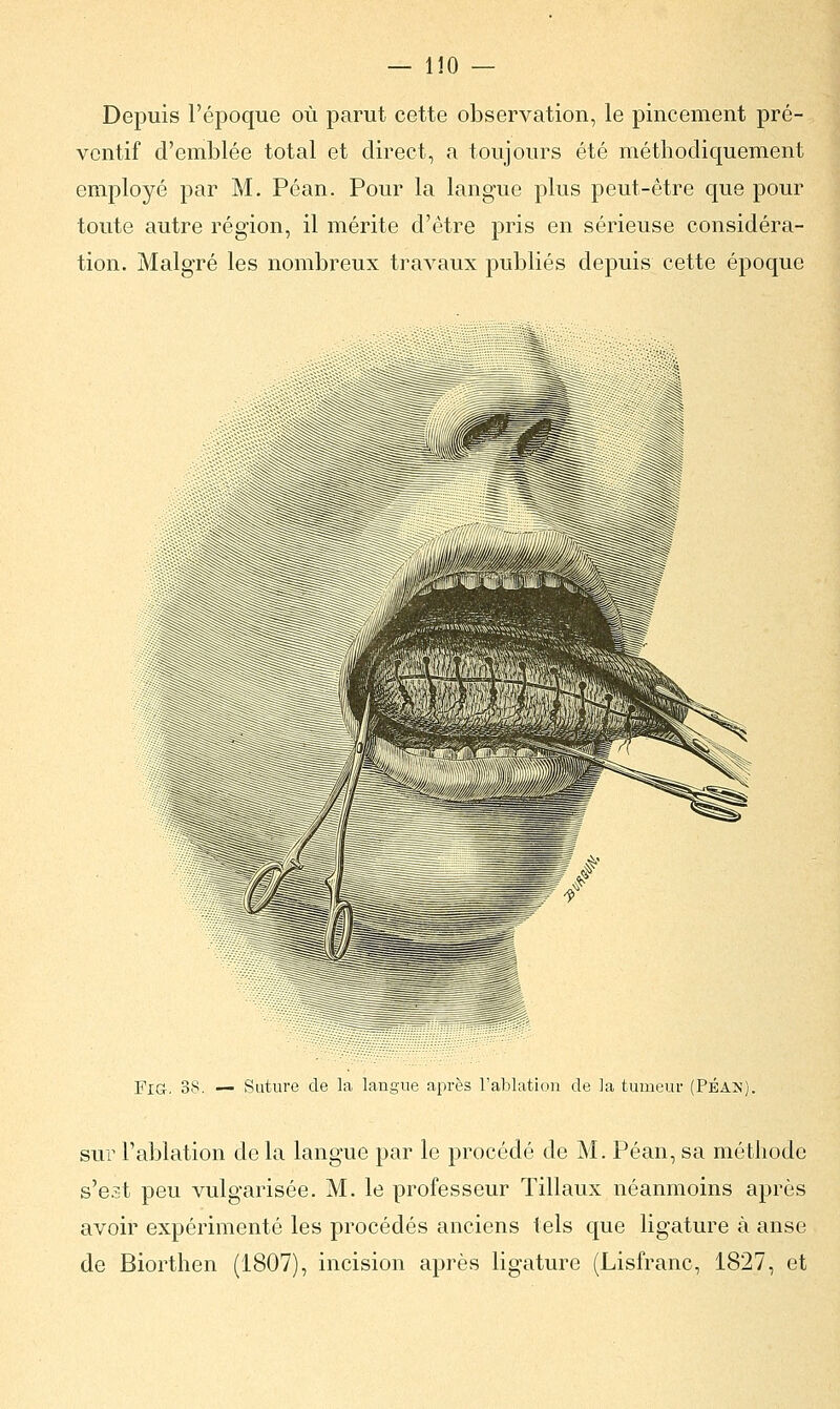 Depuis l'époque où parut cette observation, le pincement pré- ventif d'emblée total et direct, a toujours été méthodiquement employé par M. Péan. Pour la langue plus peut-être que pour toute autre région, il mérite d'être pris en sérieuse considéra- tion. Malgré les nombreux travaux publiés depuis cette époque FiG. 38. — Suture de la langue après l'ablation de la tumeur (Péak) sur l'ablation de la langue par le procédé de M. Péan, sa méthode s'est peu vulgarisée. M. le professeur Tillaux néanmoins après avoir expérimenté les procédés anciens tels que ligature à anse de Biorthen (1807), incision après ligature (Lisfranc, 1827, et