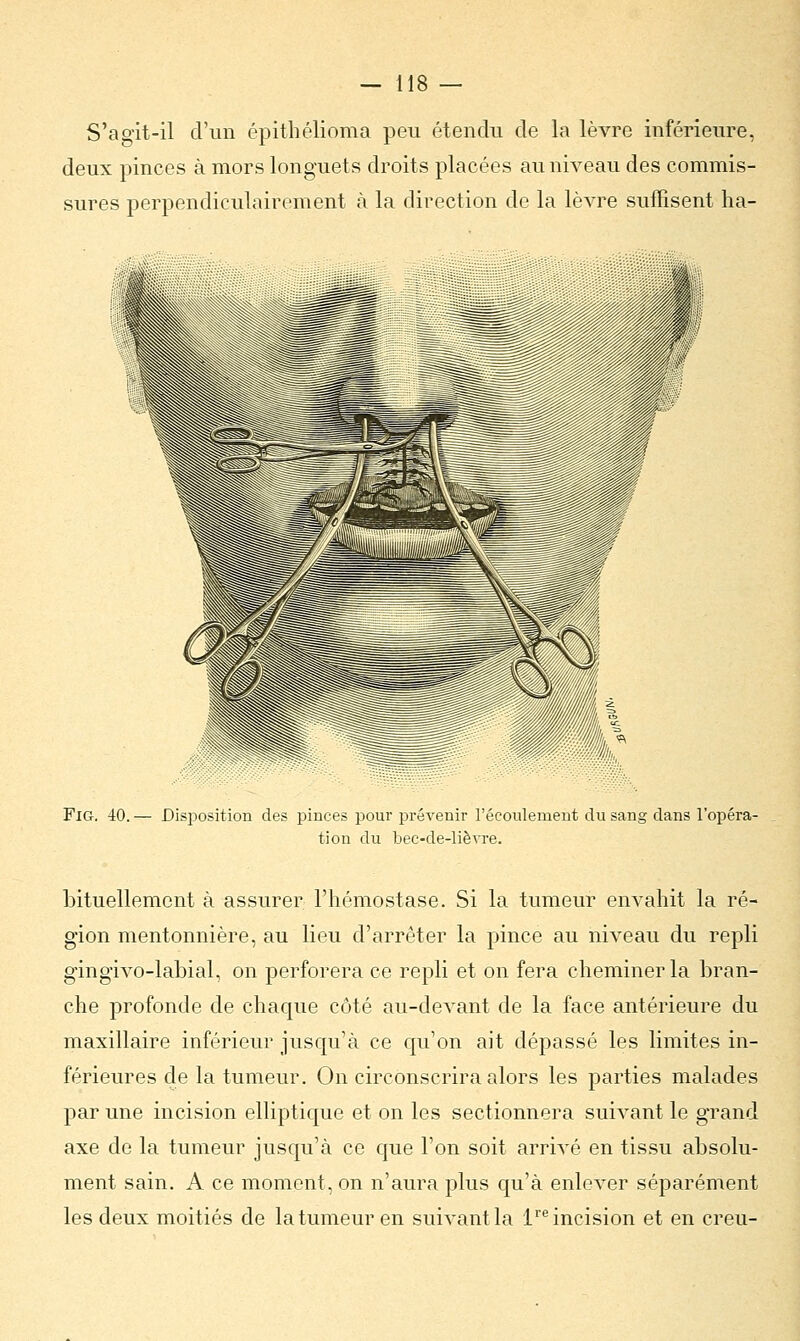 S'agit-il d'un épithélioma peu étendu de la lèvre inférieure, deux pinces à mors longuets droits placées au niveau des commis- sures perpendiculairement à la direction de la lèvre suffisent ha- FiG. 40. — Disposition des pinces pour prévenir l'écoulement du sang dans l'opéra- tion du bec-de-lièvre. bituellement à assurer l'hémostase. Si la tumeur envahit la ré- gion mentonnière, au lieu d'arrêter la pince au niveau du repli gingivo-labial, on perforera ce repli et on fera cheminer la bran- che profonde de chaque côté au-devant de la face antérieure du maxillaire inférieur jusqu'à ce qu'on ait dépassé les limites in- férieures de la tumeur. On circonscrira alors les parties malades par une incision elliptique et on les sectionnera suivant le grand axe de la tumeur jusqu'à ce que l'on soit arrivé en tissu absolu- ment sain. A ce moment, on n'aura plus qu'à enlever séparément les deux moitiés de la tumeur en suivant la lre incision et en creu-