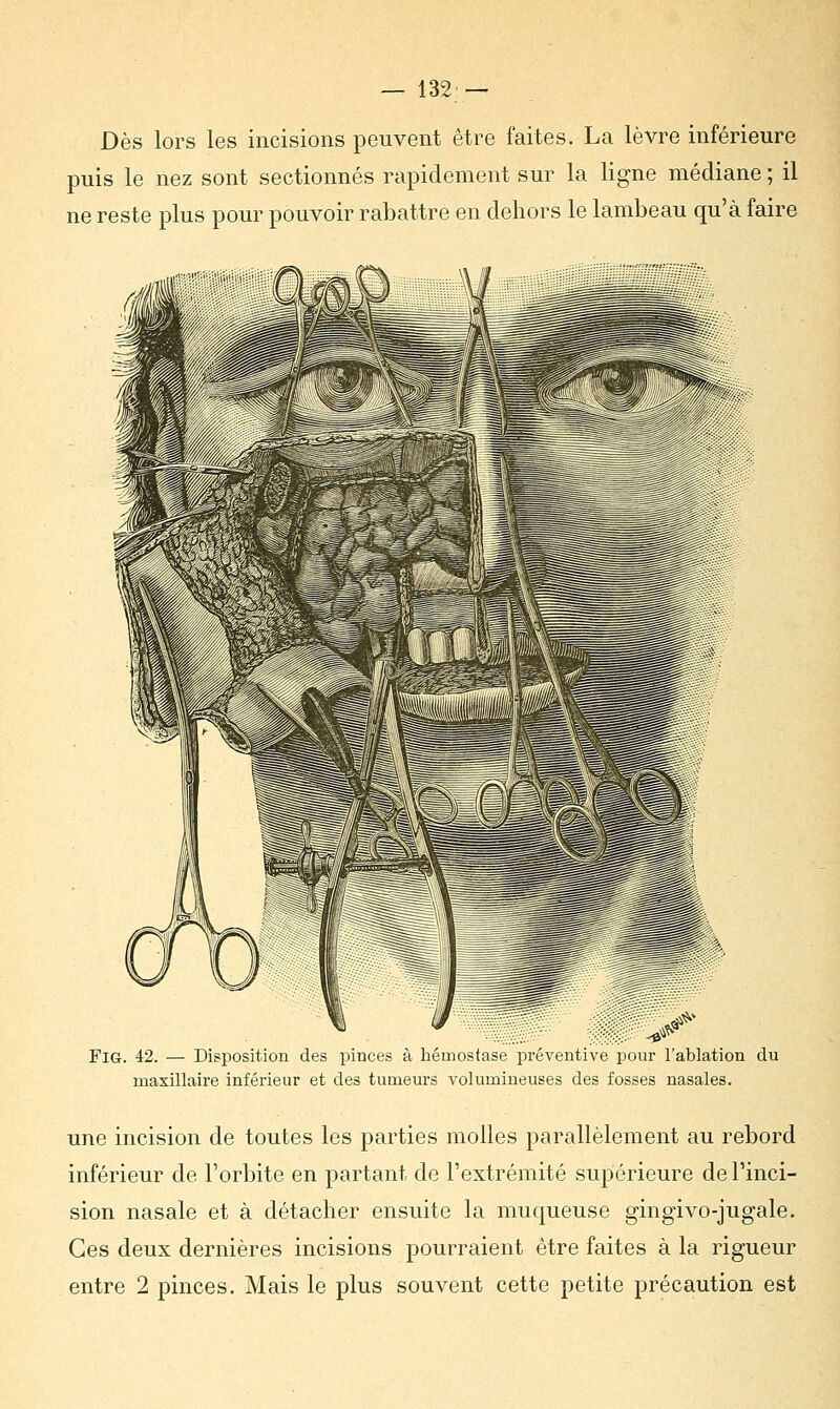 Dès lors les incisions peuvent être faites. La lèvre inférieure puis le nez sont sectionnés rapidement sur la ligne médiane ; il ne reste plus pour pouvoir rabattre en dehors le lambeau qu'à faire Fig. 42. — Disposition des pinces à hémostase préventive pour l'ablation du maxillaire inférieur et des tumeurs volumineuses des fosses nasales. une incision de toutes les parties molles parallèlement au rebord inférieur de l'orbite en partant de l'extrémité supérieure de l'inci- sion nasale et à détacher ensuite la muqueuse gingivo-jugale. Ces deux dernières incisions pourraient être faites à la rigueur entre 2 pinces. Mais le plus souvent cette petite précaution est
