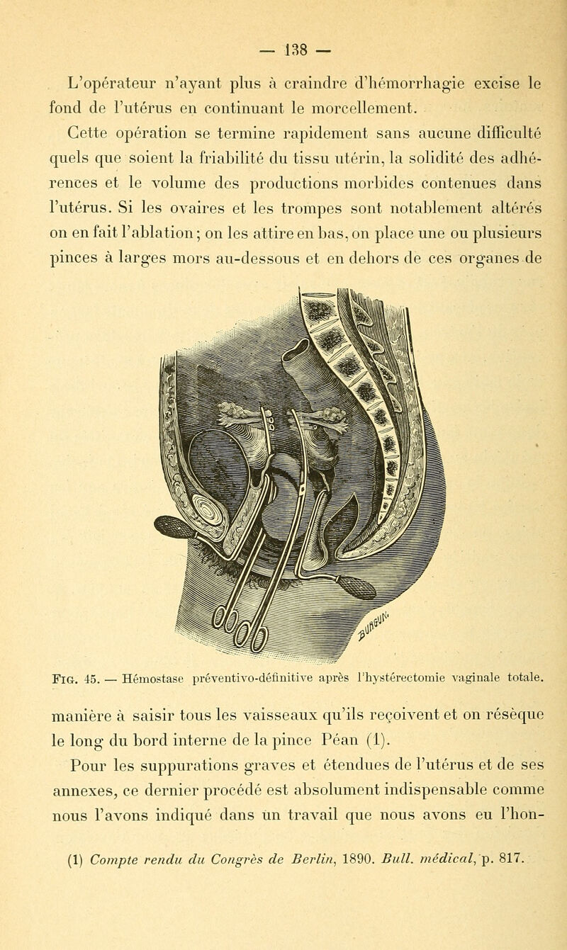 L'opérateur n'ayant plus à craindre d'hémorrhagïe excise le fond de l'utérus en continuant le morcellement. Cette opération se termine rapidement sans aucune difficulté quels que soient la friabilité du tissu utérin, la solidité des adhé- rences et le volume des productions morbides contenues dans l'utérus. Si les ovaires et les trompes sont notablement altérés on en fait l'ablation ; on les attire en bas, on place une ou plusieurs pinces à larges mors au-dessous et en dehors de ces organes de Fig. 45. — Hémostase préventivo-définitive après l'hystérectoinie vaginale totale. manière à saisir tous les vaisseaux qu'ils reçoivent et on résèque le long du bord interne de la pince Péan (1). Pour les suppurations graves et étendues de l'utérus et de ses annexes, ce dernier procédé est absolument indispensable comme nous l'avons indiqué dans un travail que nous avons eu l'hon- (1) Compte rendu du Congrès de Berlin, 1890. Bull, médical, p. 817.