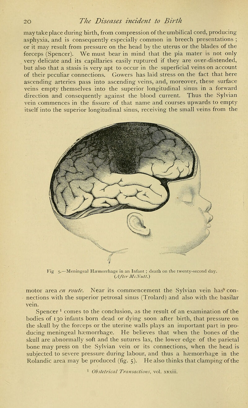 may take place during birth, from compression of the umbilical cord, producing asphyxia, and is consequently especially common in breech presentations ; or it may result from pressure on the head by the uterus or the blades of the forceps (Spencer). We must bear in mind that the pia mater is not only very delicate and its capillaries easily ruptured if they are over-distended, but also that a stasis is very apt to occur in the superficial veins on account of their peculiar connections. Gowers has laid stress on the fact that here ascending arteries pass into ascending veins, and, moreover, these surface veins empty themselves into the superior longitudinal sinus in a forward direction and consequently against the blood current. Thus the Sylvian vein commences in the fissure of that name and courses upwards to empty itself into the superior longitudinal sinus, receiving the small veins from the 'Mf^sfJf Fig 5.—Meningeal Haemorrhage in an Infant ; death on the twent^'-second day. {After McNutt.) motor area efi route. Near its commencement the Sylvian vein has^ con- nections with the superior petrosal sinus (Trolard) and also with the basilar vein. Spencer ' comes to the conclusion, as the result of an examination of the bodies of 130 infants born dead or dying soon after birth, that pressure on the skull by the forceps or the uterine walls plays an important part in pro- ducing meningeal haemorrhage. He believes that when the bones of the skull are abnormally soft and the sutures lax, the lower edge of the parietal bone may press on the Sylvian vein or its connections, when the head is subjected to severe pressure during labour, and thus a haemorrhage in the Rolandic area may be produced (fig. 5). He also thinks that clamping of the 1 Obstetrical Transactiotis, vol. .xx.xiii.