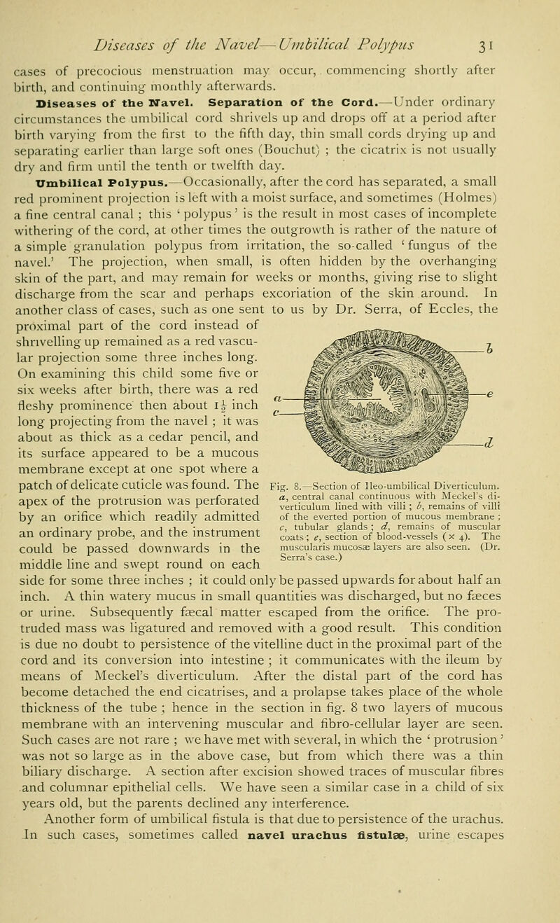 cases of precocious menstruation may occur, commencing shortly after birth, and continuing monthly afterwards. Diseases of the Navel. Separation of the Cord.—Under ordinary circumstances the umbilical cord shrivels up and drops off at a period after birth varying from the first to the fifth day, thin small cords drying up and separating earlier than large soft ones (Bouchut) ; the cicatrix is not usually dry and firm until the tenth or twelfth day. Umbilical Polypus.—Occasionally, after the cord has separated, a small red prominent projection is left with a moist surface, and sometimes (Holmes) a fine central canal ; this ' polypus ' is the result in most cases of incomplete withering of the cord, at other times the outgrowth is rather of the nature ot a simple granulation polypus from irritation, the so-called 'fungus of the navel.' The projection, when small, is often hidden by the overhanging skin of the part, and may remain for weeks or months, giving rise to slight discharge from the scar and perhaps excoriation of the skin around. In another class of cases, such as one sent to us by Dr. Serra, of Eccles, the proximal part of the cord instead of shrivelling up remained as a red vascu- lar projection some three inches long. On examining this child some five or six weeks after birth, there was a red fleshy prominence then about ih inch long projecting from the navel ; it was about as thick as a cedar pencil, and its surface appeared to be a mucous membrane except at one spot where a patch of delicate cuticle was found. The apex of the protrusion was perforated by an orifice which readily admitted an ordinary probe, and the instrument could be passed downwards in the middle line and swept round on each side for some three inches ; it could only be passed upwards for about half an inch. A thin watery mucus in small quantities was discharged, but no fasces or urine. Subsequently fscal matter escaped from the orifice. The pro- truded mass was ligatured and removed with a good result. This condition is due no doubt to persistence of the vitelline duct in the proximal part of the cord and its conversion into intestine ; it communicates with the ileum by means of Meckel's diverticulum. After the distal part of the cord has become detached the end cicatrises, and a prolapse takes place of the whole thickness of the tube ; hence in the section in fig. 8 two layers of mucous membrane with an intervening muscular and fibro-cellular layer are seen. Such cases are not rare ; we have met with several, in which the ' protrusion' was not so large as in the above case, but from which there was a thin biliary discharge. A section after excision showed traces of muscular fibres and columnar epithelial cells. We have seen a similar case in a child of six years old, but the parents declined any interference. Another form of umbilical fistula is that due to persistence of the urachus. In such cases, sometimes called navel urachus fistulae, urine escapes Fig. 8, Section of lleo-umbilical Diverticulum a, central canal continuous with Meckel's di verticulum lined with villi ; b, remains of vill of the everted portion of mucous membrane c, tubular glands ; d, remains of muscular coats; e, section of blood-vessels (x 4). The muscularis mucosae layers are also seen. (Dr. Serra's case.)