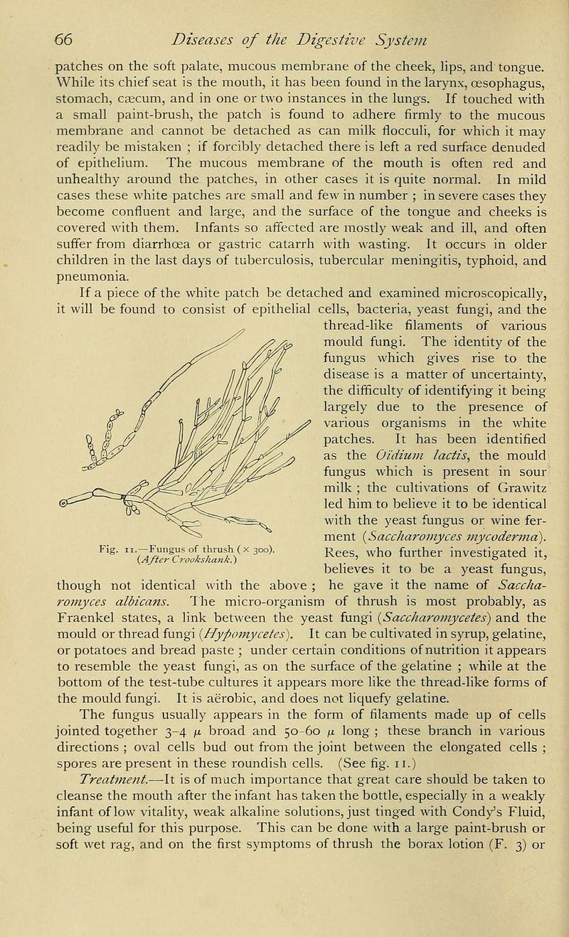 patches on the soft palate, mucous membrane of the cheek, h'ps, and tongue. While its chief seat is the mouth, it has been found in the larynx, oesophagus, stomach, Ccecum, and in one or two instances in the lungs. If touched with a small paint-brush, the patch is found to adhere firmly to the mucous membrane and cannot be detached as can milk flocculi, for which it may readily be mistaken ; if forcibly detached there is left a red surface denuded of epithelium. The mucous membrane of the mouth is often red and unhealthy around the patches, in other cases it is quite normal. In mild cases these white patches are small and few in number ; in severe cases they become confluent and large, and the surface of the tongue and cheeks is covered with them. Infants so affected are mostly weak and ill, and often suffer from diarrhcea or gastric catarrh with wasting. It occurs in older children in the last days of tuberculosis, tubercular meningitis, typhoid, and pneumonia. If a piece of the white patch be detached and examined microscopically, it will be found to consist of epithelial cells, bacteria, yeast fungi, and the thread-like filaments of various mould fungi. The identity of the fungus which gives rise to the disease is a matter of uncertainty, the difficulty of identifying it being largely due to the presence of various organisms in the white patches. It has been identified as the Oidium lactis, the mould fungus which is present in sour milk ; the cultivations of Grawitz led him to believe it to be identical with the yeast fungus or wine fer- ment {^Saccharoniyces mycoderma). Rees, who further investigated it, believes it to be a yeast fungus, though not identical with the above ; he gave it the name of Saccha- roniyces albicans. The micro-organism of thrush is most probably, as Fraenkel states, a link between the yeast fungi {Saccharomyceies) and the mould or thread fungi {Hypomycetes). It can be cultivated in syrup, gelatine, or potatoes and bread paste ; under certain conditions of nutrition it appears to resemble the yeast fungi, as on the surface of the gelatine ; while at the bottom of the test-tube cultures it appears more like the thread-like forms of the mould fungi. It is aerobic, and does not liquefy gelatine. The fungus usually appears in the form of filaments made up of cells jointed together 3-4 /a broad and 50-60 /n long ; these branch in various directions ; oval cells bud out from the joint between the elongated cells ; spores are present in these roundish cells. (See fig. 11.) Treatment.—^It is of much importance that great care should be taken to cleanse the mouth after the infant has taken the bottle, especially in a weakly infant of low vitality, weak alkaline solutions, just tinged with Condy's Fluid, being useful for this purpose. This can be done with a large paint-brush or soft wet rag, and on the first symptoms of thrush the borax lotion (F. 3) or ;.—Fungus of thrush (x 300). (A/ter Crookshank.)