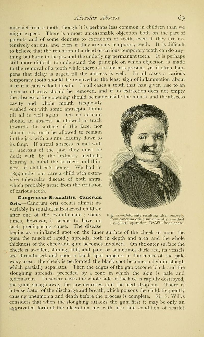 mischief from a tooth, though it is perhaps less common in children than we might expect. There is a most unreasonable objection both on the part of parents and of some dentists to extraction of teeth, even if they are ex- tensively carious, and even if they are only temporary teeth. It is difficult to believe that the retention of a dead or carious temporary tooth can do any- thing but harm to the jaw and the underlying permanent teeth. It is perhaps still more difficult to understand the principle on which objection is made to the removal of a tooth while there is an abscess present, yet it often hap- pens that delay is urged till the abscess is well. In all cases a carious temporary tooth should be removed at the least sign of inflammation about it or if it causes foul breath. In all cases a tooth that has given rise to an alveolar abscess should be removed, and if its extraction does not empty the abscess a free opening should be made inside the mouth, and the abscess cavity and whole mouth frequently washed out with some antiseptic lotion till all is well again. On no account should an abscess be allowed to track towards the surface of the face, nor should any tooth be allowed to remain in the jaw with a sinus leading down to its fang. If antral abscess is met with or necrosis of the jaw, they must be dealt with by the ordinary methods, bearing in mind the softness and thin- ness of children's bones. We had in 1895 under our care a child with exten- sive tubercular disease of both antra, which probably arose from the irritation of carious teeth. Gangrenous Stomatitis. Cancrum Oris.—Cancrum oris occurs almost in- variably in squalid, half-starved children after one of the exanthemata ; some- times, however, it seems to have no such predisposing cause. The disease begins as an inflamed spot on the inner surface of the cheek or upon the gum, the mischief rapidly spreads, both in depth and area, and the whole thickness of the cheek and gum becomes involved. On the outer surface the cheek is swollen, shining, stiff, and pale, or sometimes dark red, its vessels are thrombosed, and soon a black spot appears in the centre of the pale waxy area ; the cheek is perforated, the black spot becomes a definite slough which partially separates. Then the edges of the gap become black and the sloughing spreads, preceded by a zone in which the skin is pale and cedcmatous. In severe cases the whole side of the face is rapidly destroyed, the gums slough away, the jaw necroses, and the teeth drop out. There is intense foetor of the discharge and breath, which poisons the child, frequently causing pneumonia and death before the process is complete. Sir S. Wilks considers that when the sloughing attacks the gum first it may be only an aggravated form of the ulceration met with in a late condition of scarlet Fig. 12.—Deformity resulting after recovery from cancrum oris ; subsequently remedied by a plastic operation. Dr. Wilkinson's case.