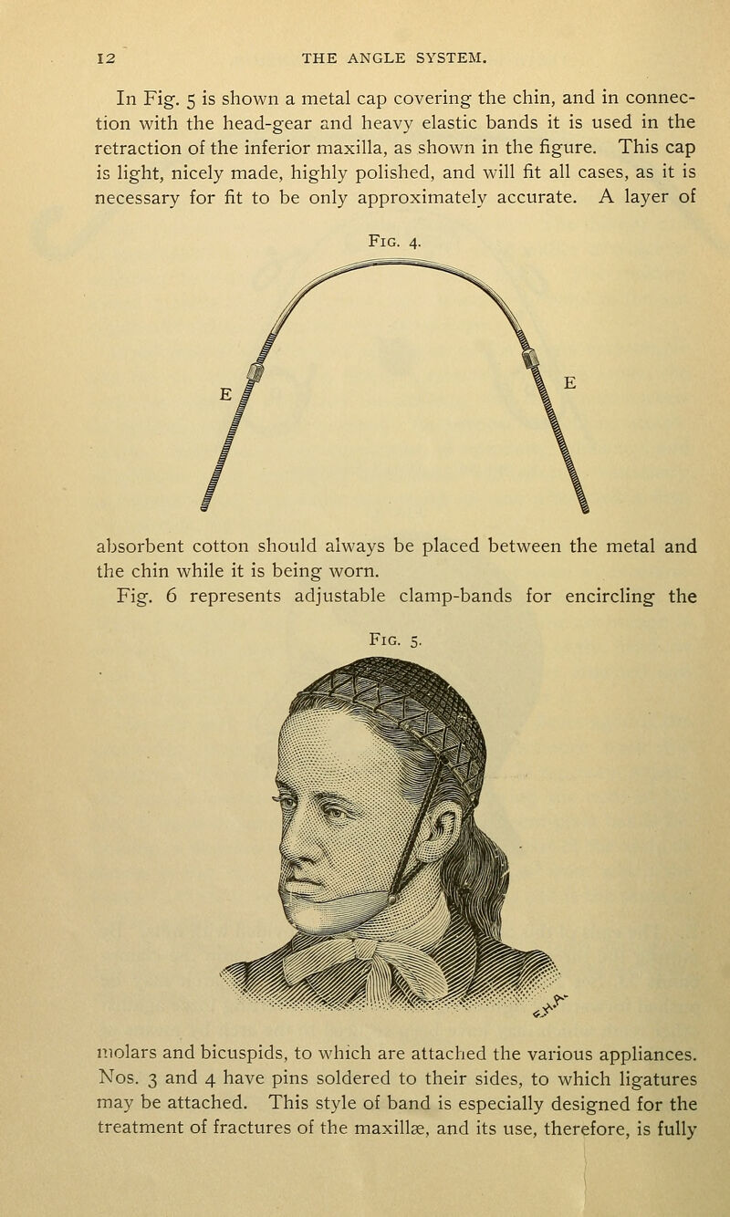 In Fig. 5 is shown a metal cap covering the chin, and in connec- tion with the head-gear and heavy elastic bands it is used in the retraction of the inferior maxilla, as shown in the figure. This cap is light, nicely made, highly polished, and will fit all cases, as it is necessary for fit to be only approximately accurate. A layer of Fig. 4. absorbent cotton should always be placed between the metal and the chin while it is being worn. Fig. 6 represents adjustable clamp-bands for encircling the Fig. ^. molars and bicuspids, to which are attached the various appliances. Nos. 3 and 4 have pins soldered to their sides, to which ligatures may be attached. This style of band is especially designed for the treatment of fractures of the maxillse, and its use, therefore, is fully