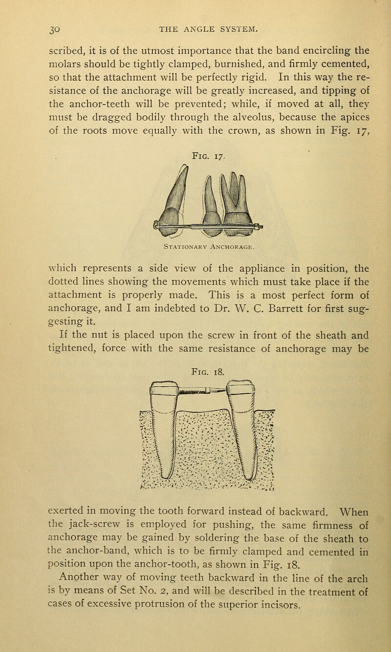 scribed, it is of the utmost importance that the band encircling the molars should be tightly clamped, burnished, and firmly cemented, so that the attachment will be perfectly rigid. In this way the re- sistance of the anchorage will be greatly increased, and tipping of the anchor-teeth will be prevented; while, if moved at all, they must be dragged bodily through the alveolus, because the apices of the roots move equally with the crown, as shown in Fig. 17, Fig. 17. Stationary Anchorage. which represents a side view of the appliance in position, the dotted lines showing the movements which must take place if the attachment is properly made. This is a most perfect form of anchorage, and I am indebted to Dr. W. C. Barrett for first sug- gesting it. If the nut is placed upon the screw in front of the sheath and tightened, force with the same resistance of anchorage may be Fig. 18. >ir:-- 'Mf.-:^. iV'^:^?; exerted in moving the tooth forward instead of backward. When the jack-screw is employed for pushing, the same firmness of anchorage may be gained by soldering the base of the sheath to the anchor-band, which is to be firmly clamped and cemented in position upon the anchor-tooth, as shown in Fig. 18. Another way of moving teeth backward in the line of the arch is by means of Set No. 2, and will be described in the treatment of cases of excessive protrusion of the superior incisors.