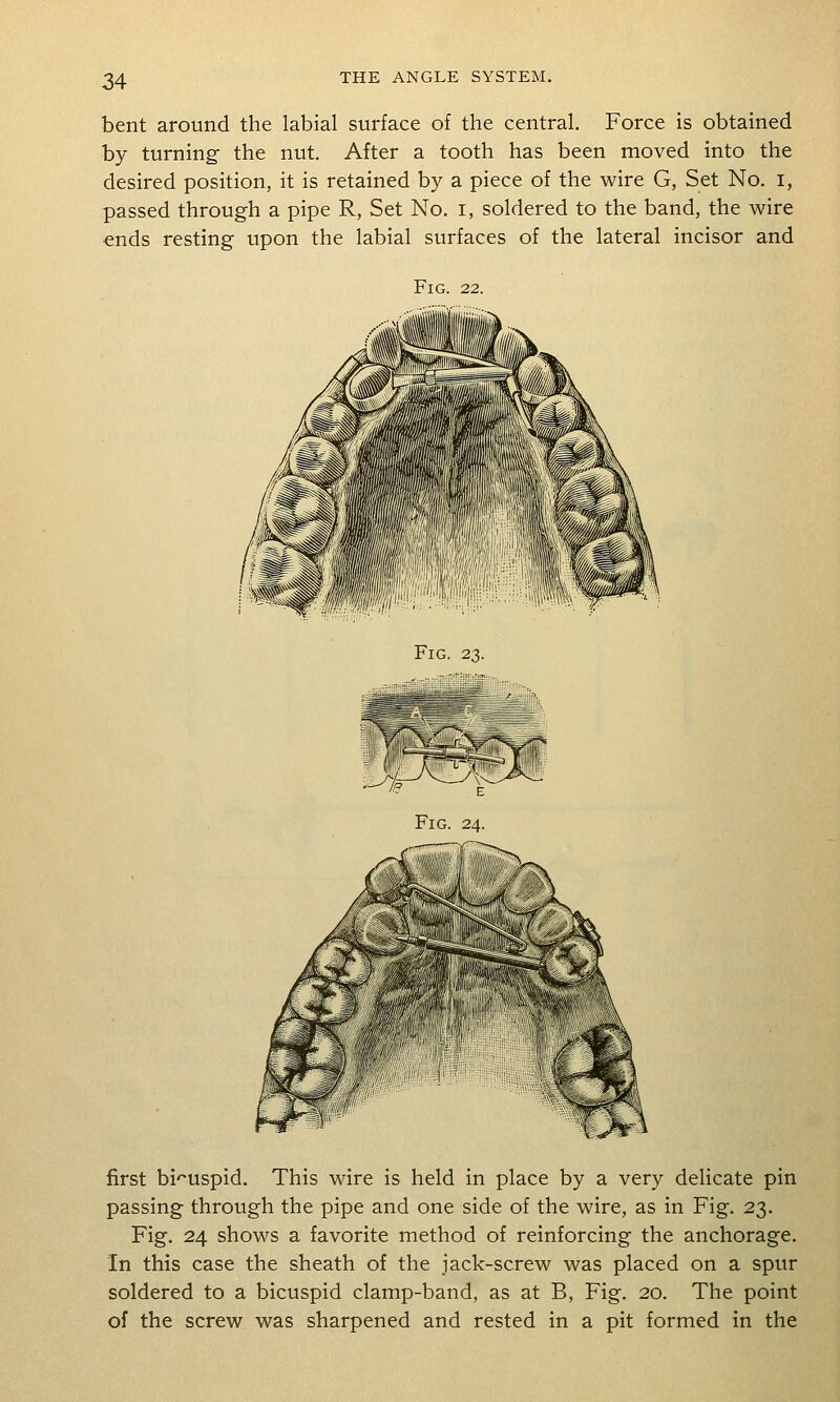 bent around the labial surface of the central. Force is obtained by turning- the nut. After a tooth has been moved into the desired position, it is retained by a piece of the wire G, Set No. i, passed through a pipe R, Set No. i, soldered to the band, the wire ends resting upon the labial surfaces of the lateral incisor and Fig. 22. Fig. 23. Fig. 24. first bi'^uspid. This wire is held in place by a very delicate pin passing through the pipe and one side of the wire, as in Fig. 23. Fig. 24 shows a favorite method of reinforcing the anchorage. In this case the sheath of the jack-screw was placed on a spur soldered to a bicuspid clamp-band, as at B, Fig. 20. The point of the screw was sharpened and rested in a pit formed in the