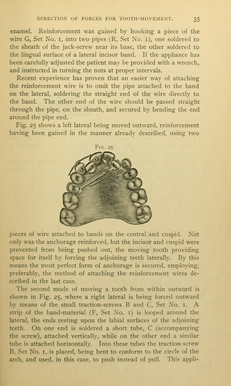 enamel. Reinforcement was gained by hooking a piece of the wire G, Set No. i, into two pipes (R, Set No. i), one soldered to the sheath of the jack-screw near its base, the other soldered to the lingual surface of a lateral incisor band. If the appliance has been carefully adjusted the patient may be provided with a wrench, and instructed in turning the nuts at proper intervals. Recent experience has proven that an easier way of attaching the reinforcement wire is to omit the pipe attached to the band on the lateral, soldering the straight end of the wire directly to the band. The other end of the wire should be passed straight through the pipe, on the sheath, and secured by bending the end around the pipe end. Fig. 25 shows a left lateral being moved outward, reinforcement having been gained in the manner already described, using two Fig. 2;. pieces of wire attached to bands on the central and cuspid. Not only was the anchorage reinforced, but the incisor and cuspid were prevented from being pushed out, the moving tooth providing space for itself by forcing the adjoining teeth laterally. By this means the most perfect form of anchorage is secured, employing, preferably, the method of attaching the reinforcement wires de- scribed in the last case. The second mode of moving a tooth from within outward is shown in Fig. 25, where a right lateral is being forced outward by means of the stnall traction-screws B and C, Set No. i. A strip of the band-material (F, Set No. i) is looped around the lateral, the ends resting upon the labial surfaces of the adjoining teeth. On one end is soldered a short tube, C (accompanying the screw), attached vertically, while on the other end a similar tube is attached horizontally. Into these tubes the traction-screw E, Set No. I, is placed, being bent to conform to the circle of the arch, and used, in this case, to push instead of pull. This appli-