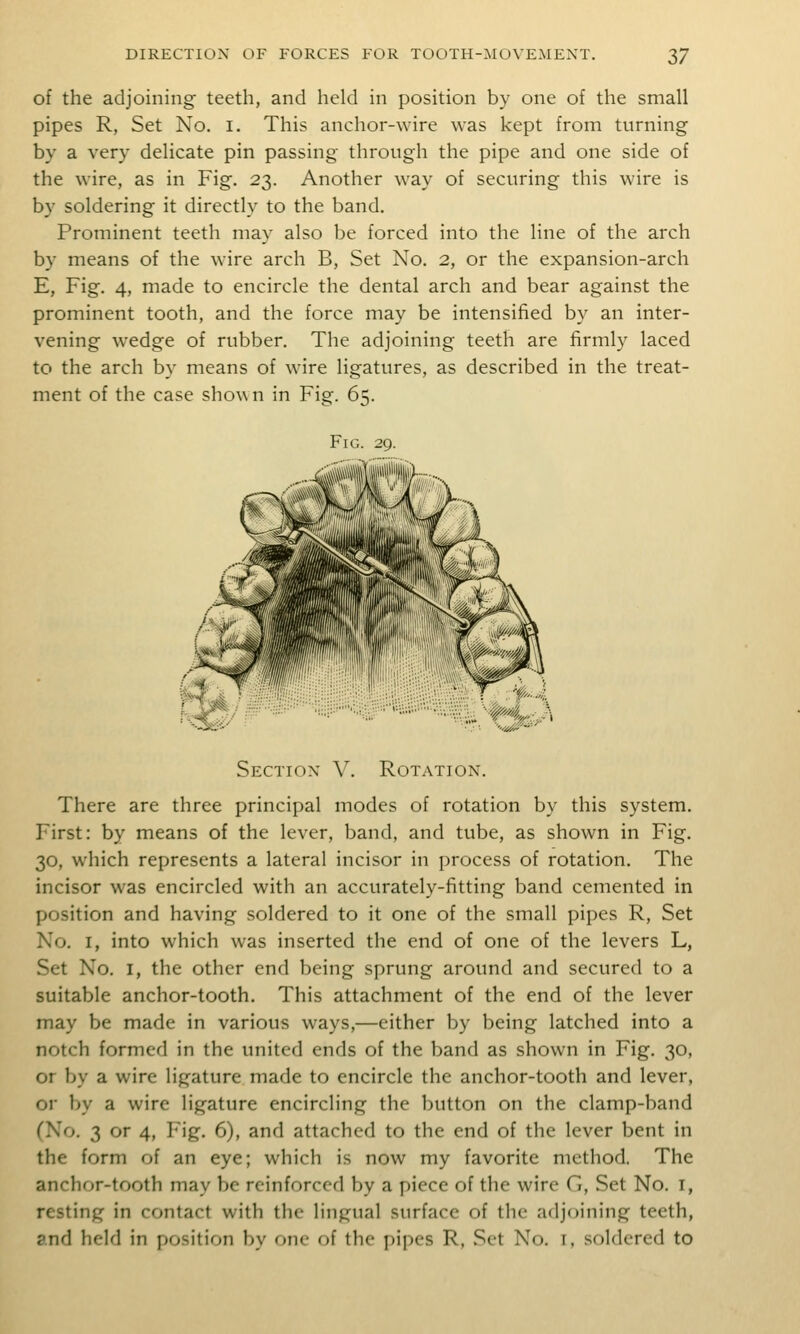 of the adjoining teeth, and held in position by one of the small pipes R, Set No. i. This anchor-wire was kept from turning by a very delicate pin passing through the pipe and one side of the wire, as in Fig. 23. Another way of securing this wire is by soldering it directly to the band. Prominent teeth may also be forced into the line of the arch by means of the wire arch B, Set No. 2, or the expansion-arch E, Fig. 4, made to encircle the dental arch and bear against the prominent tooth, and the force may be intensified by an inter- vening wedge of rubber. The adjoining teeth are firmly laced to the arch by means of wire ligatures, as described in the treat- ment of the case shown in Fig. 65. Fig. 29. Section V. Rotation. There are three principal modes of rotation by this system. First: by means of the lever, band, and tube, as shown in Fig. 30, which represents a lateral incisor in process of rotation. The incisor was encircled with an accurately-fitting band cemented in position and having soldered to it one of the small pipes R, Set No. I, into which was inserted the end of one of the levers L, Set No. I, the other end being sprung around and secured to a suitable anchor-tooth. This attachment of the end of the lever may be made in various ways,—either by being latched into a notch formed in the united ends of the band as shown in Fig. 30, or by a wire ligature made to encircle the anchor-tooth and lever, or by a wire ligature encircling the button on the clamp-band CNo. 3 or 4, Fig. 6), and attached to the end of the lever bent in the form of an eye; which is now my favorite method. The anchor-tooth may be reinforced by a piece of the wire G, Set No. i, resting in contact with the lingual surface of the adjoining teeth, and held in position by one of the pipes R, Set No. i, soldered to