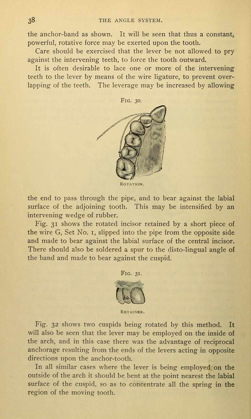the anchor-band as shown. It will be seen that thus a constant, powerful, rotative force may be exerted upon the tooth. Care should be exercised that the lever be not allowed to pry against the intervening teeth, to force the tooth outward. It is often desirable to lace one or more of the intervening teeth to the lever by means of the wire ligature, to prevent over- lapping of the teeth. The leverage may be increased by allowing Fig. 30. the end to pass through the pipe, and to bear against the labial surface of the adjoining tooth. This may be intensified by an intervening wedge of rubber. Fig. 31 shows the rotated incisor retained by a short piece of the wire G, Set No. i, slipped into the pipe from the opposite side and made to bear against the labial surface of the central incisor. There should also be soldered a spur to the disto-lingual angle of the band and made to bear against the cuspid. Fig. 31. Retainer. Fig. 32 shows two cuspids being rotated by this method. It will also be seen that the lever may be employed on the inside of the arch, and in this case there was the advantage of reciprocal anchorage resulting from the ends of the levers acting in opposite directions upon the anchor-tooth. In all similar cases where the lever is being employed, on the outside of the arch it should be bent at the point nearest the labial surface of the cuspid, so as to concentrate all the spring in the region of the moving tooth.